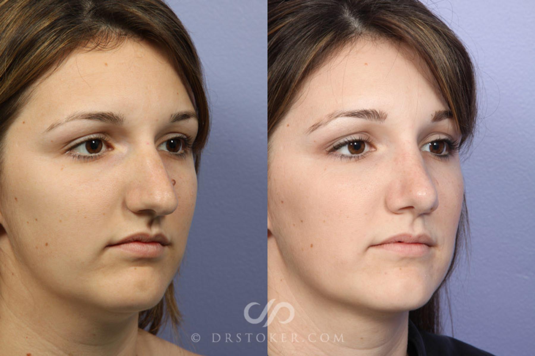 Before & After Rhinoplasty Case 334 View #2 View in Los Angeles, CA