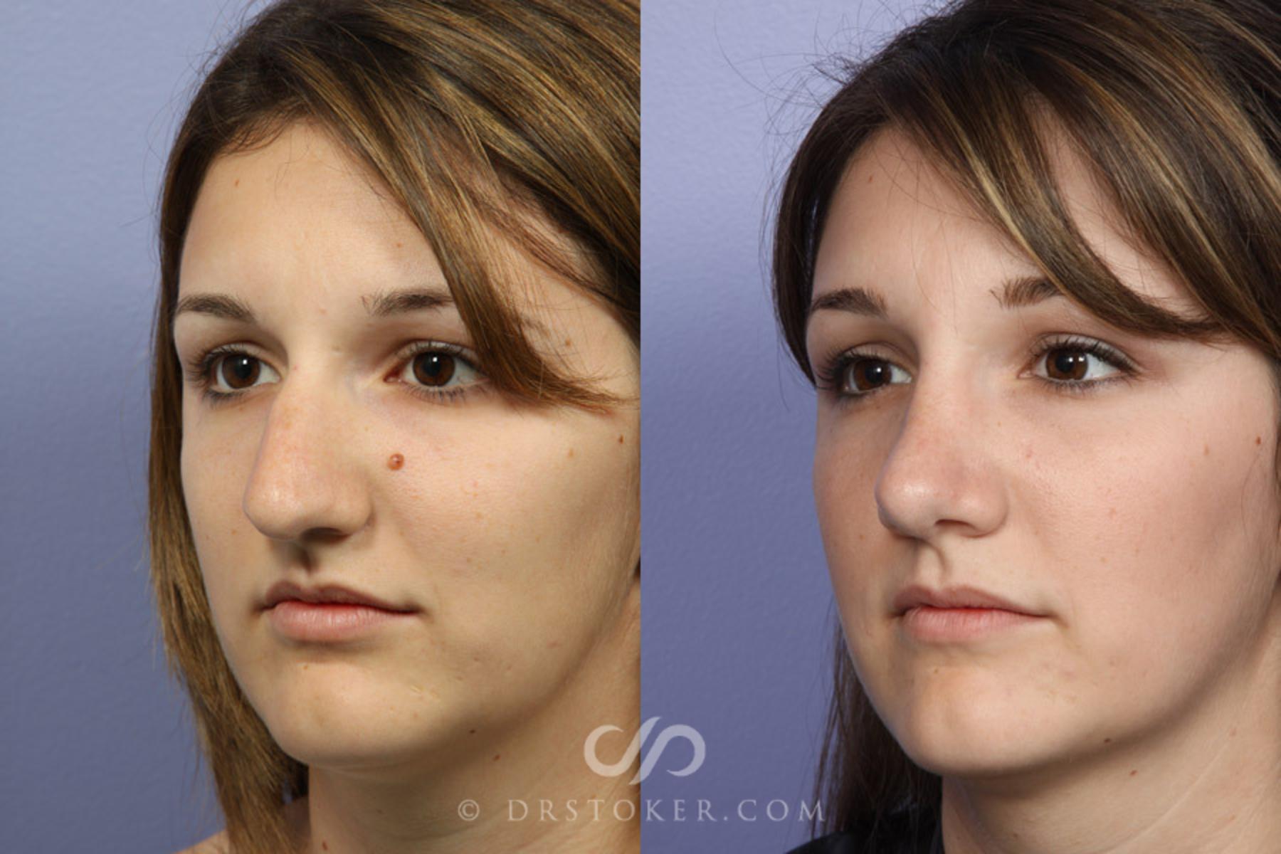 Before & After Rhinoplasty Case 334 View #3 View in Los Angeles, CA