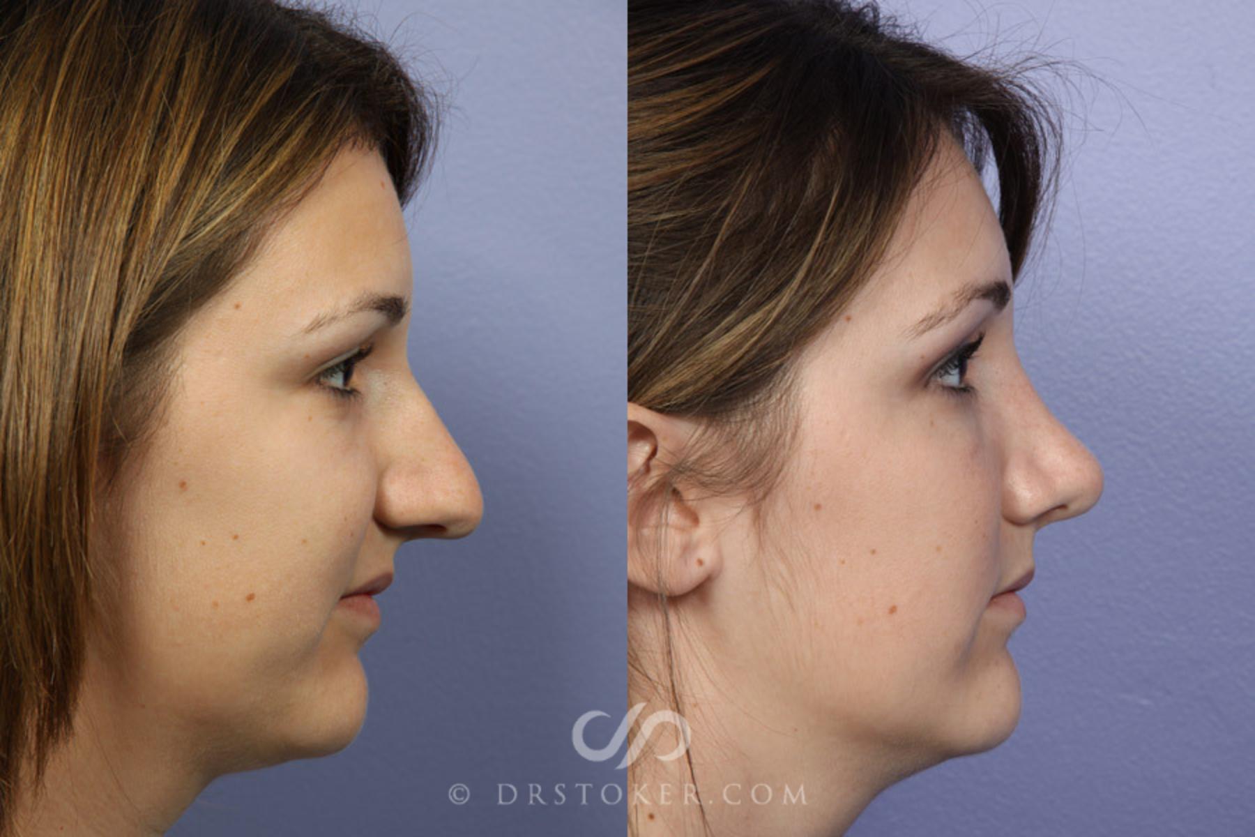 Before & After Rhinoplasty Case 334 View #4 View in Los Angeles, CA