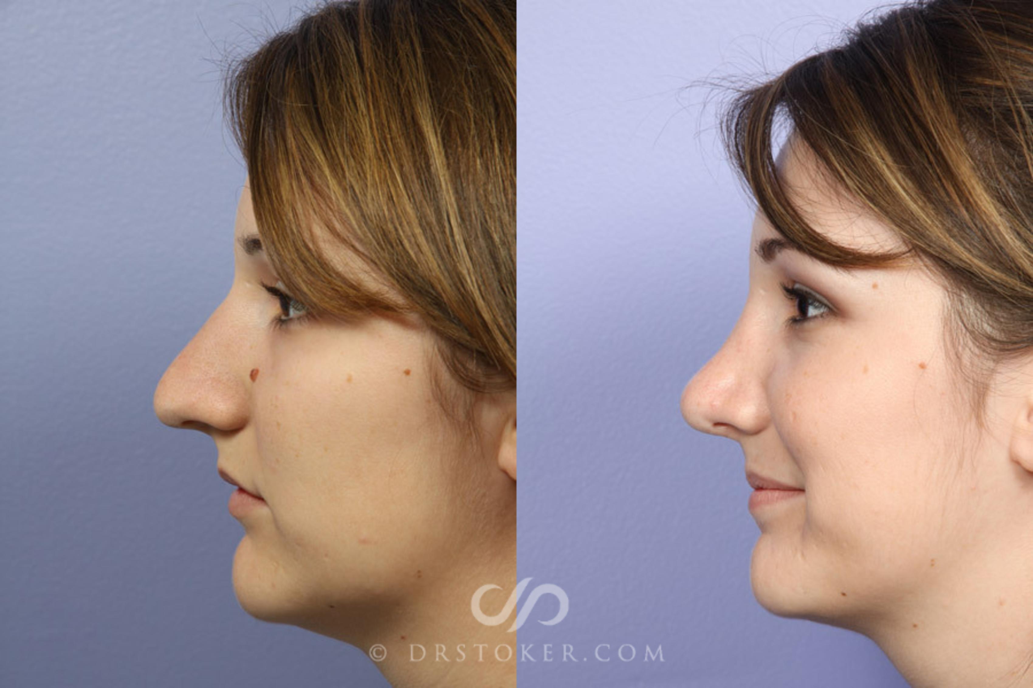 Before & After Rhinoplasty Case 334 View #5 View in Los Angeles, CA