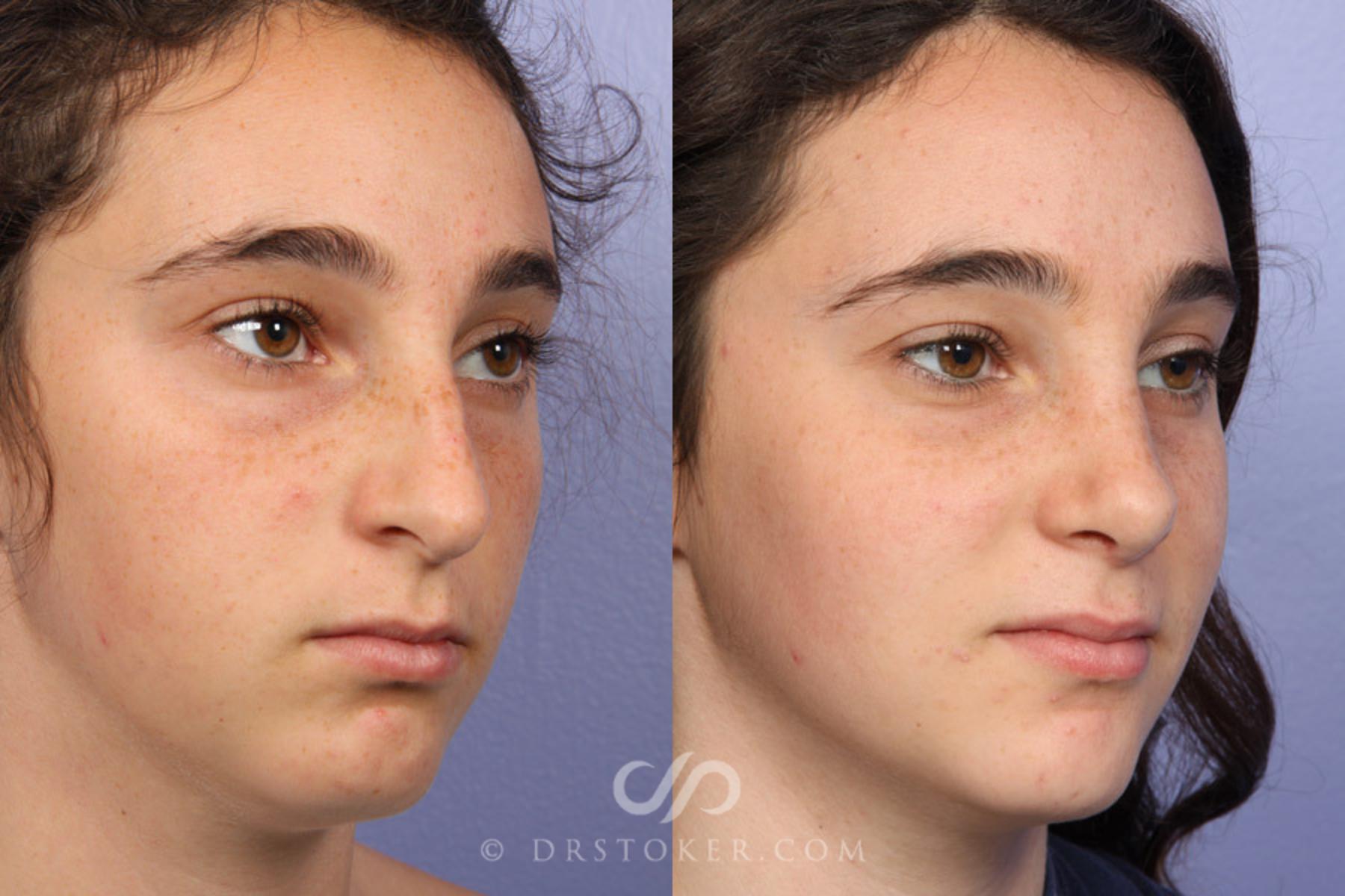 Before & After Rhinoplasty Case 335 View #2 View in Los Angeles, CA