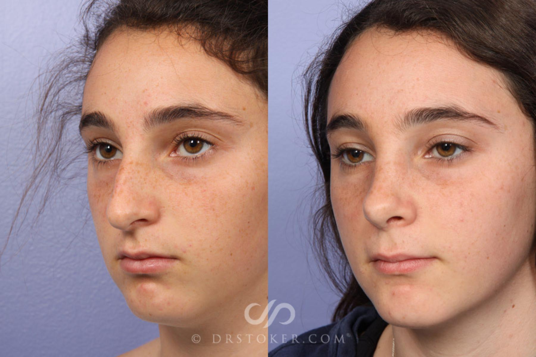 Before & After Rhinoplasty Case 335 View #3 View in Los Angeles, CA