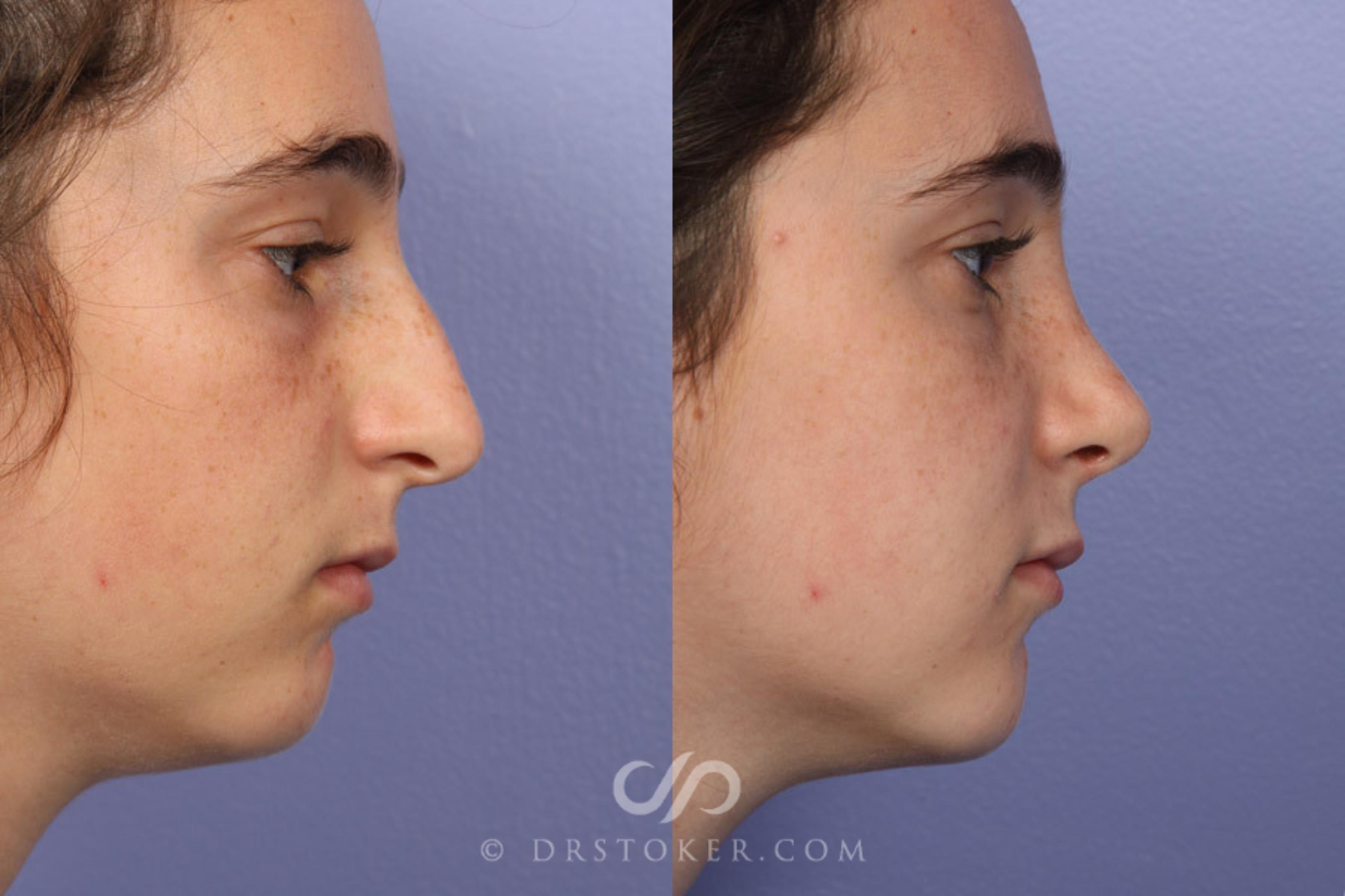 Before & After Rhinoplasty Case 335 View #4 View in Los Angeles, CA