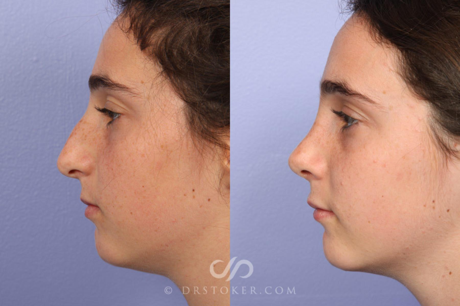 Before & After Rhinoplasty Case 335 View #5 View in Los Angeles, CA