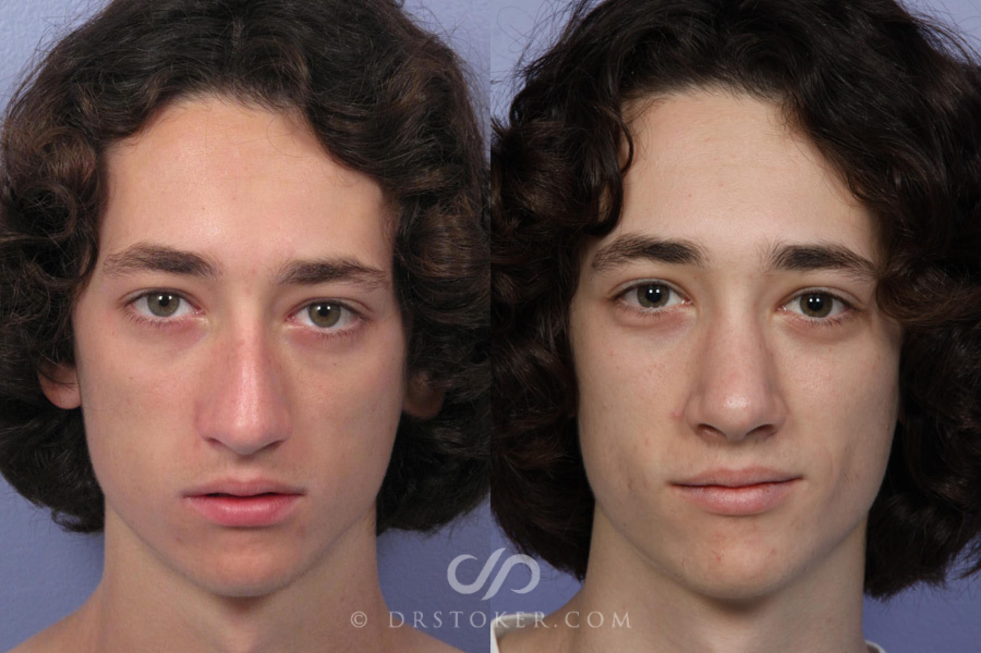 Before & After Rhinoplasty Case 350 View #1 View in Los Angeles, CA