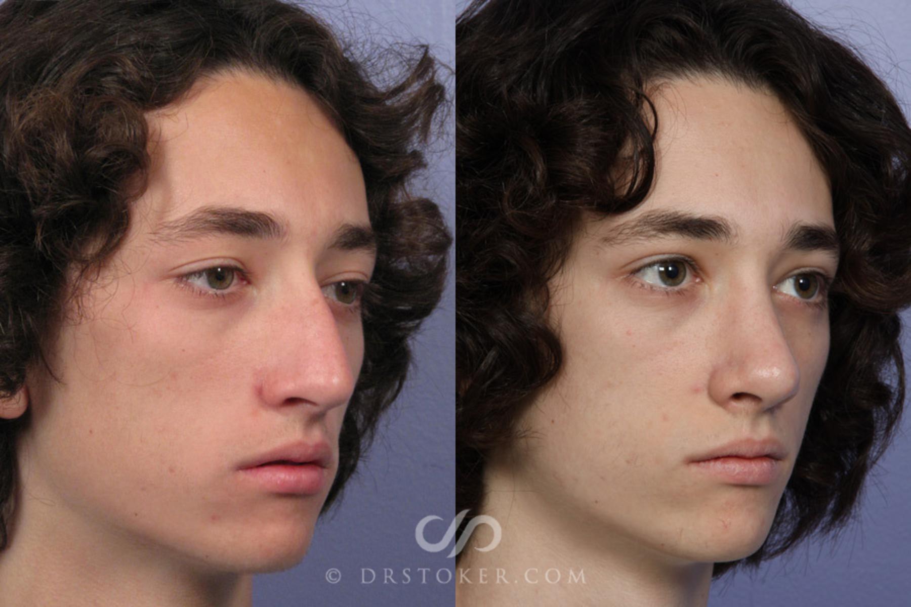 Before & After Rhinoplasty Case 350 View #2 View in Los Angeles, CA
