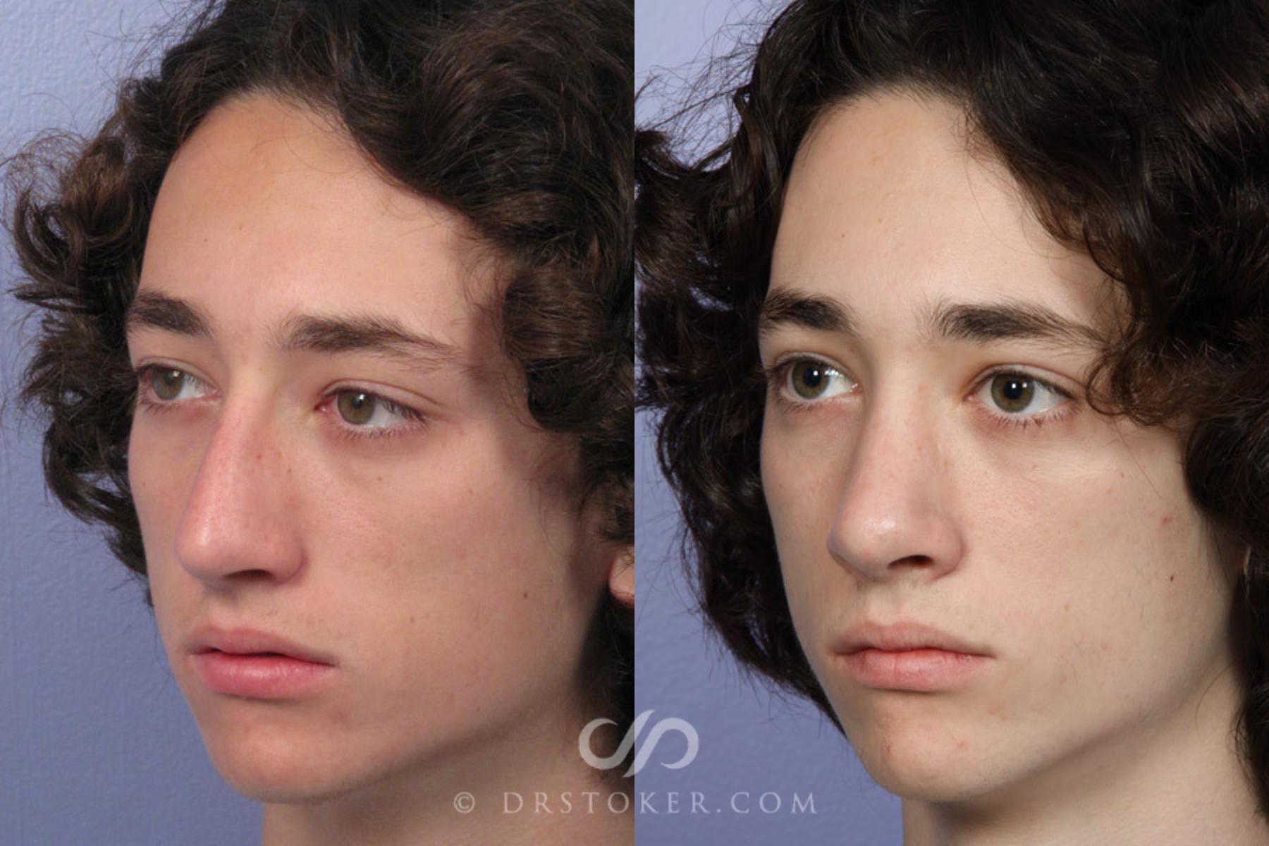 Before & After Rhinoplasty Case 350 View #3 View in Los Angeles, CA