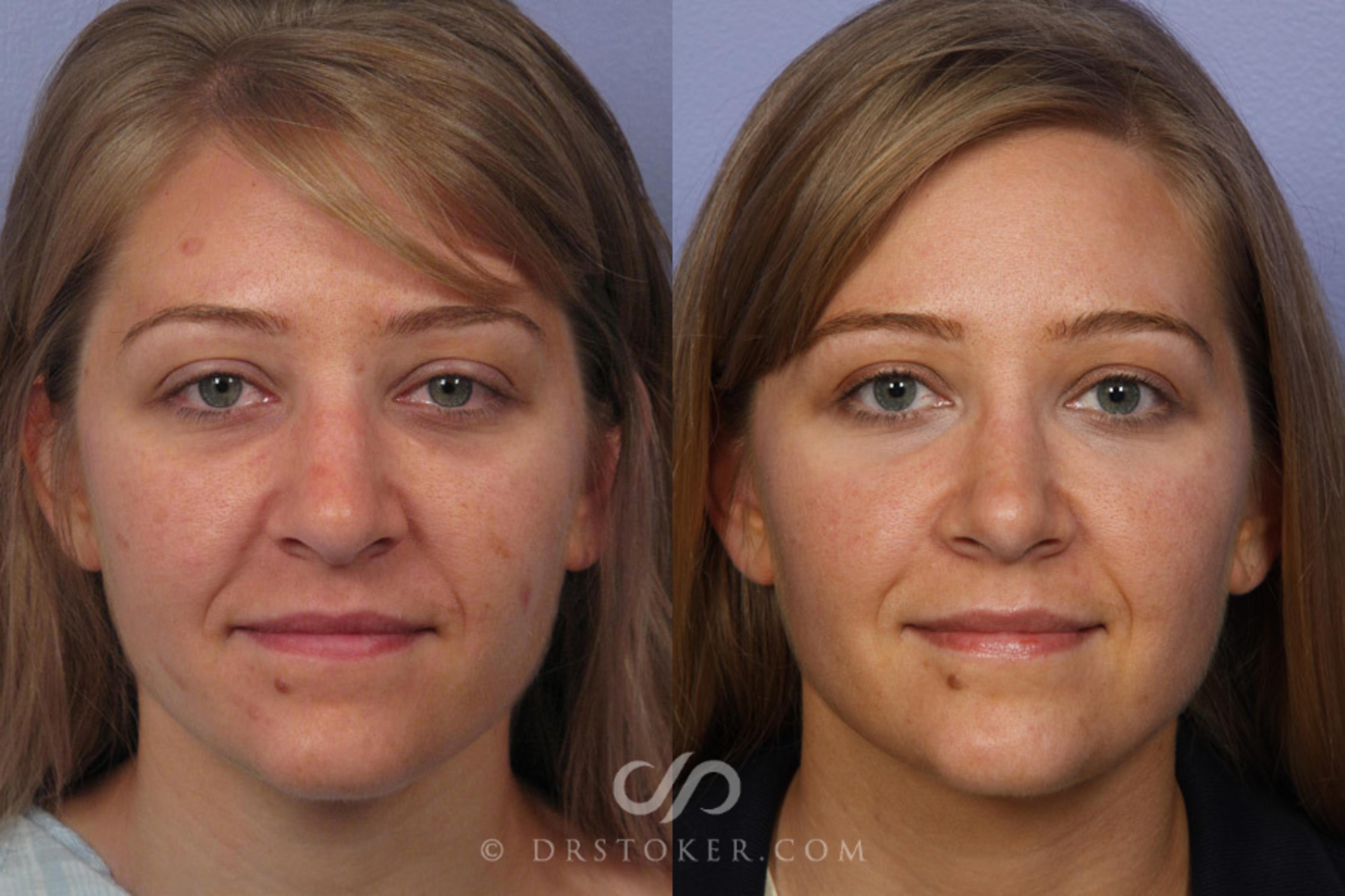Before & After Rhinoplasty Case 351 View #1 View in Los Angeles, CA
