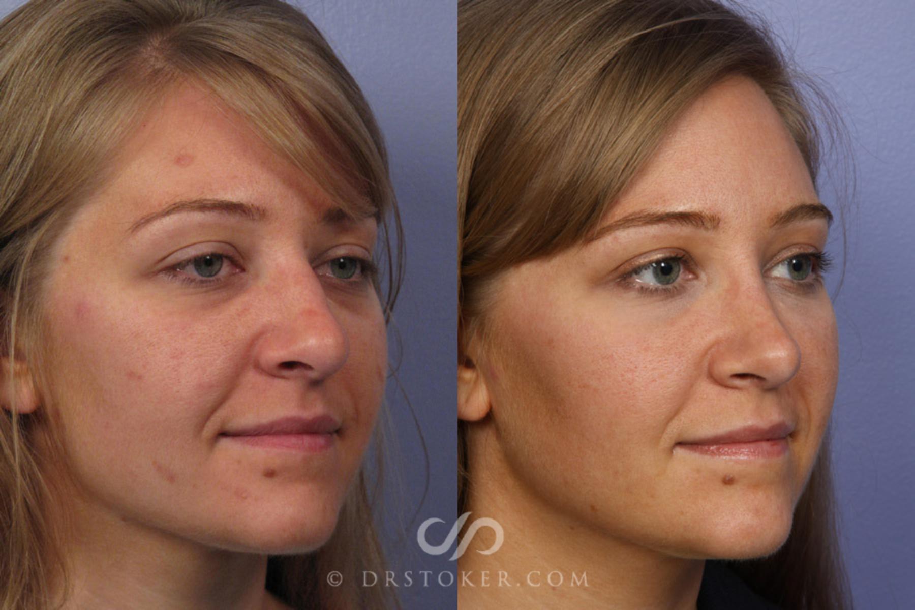 Before & After Rhinoplasty Case 351 View #2 View in Los Angeles, CA