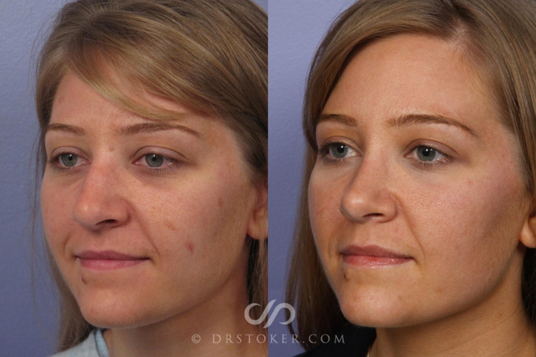 Before & After Rhinoplasty Case 351 View #3 View in Los Angeles, CA