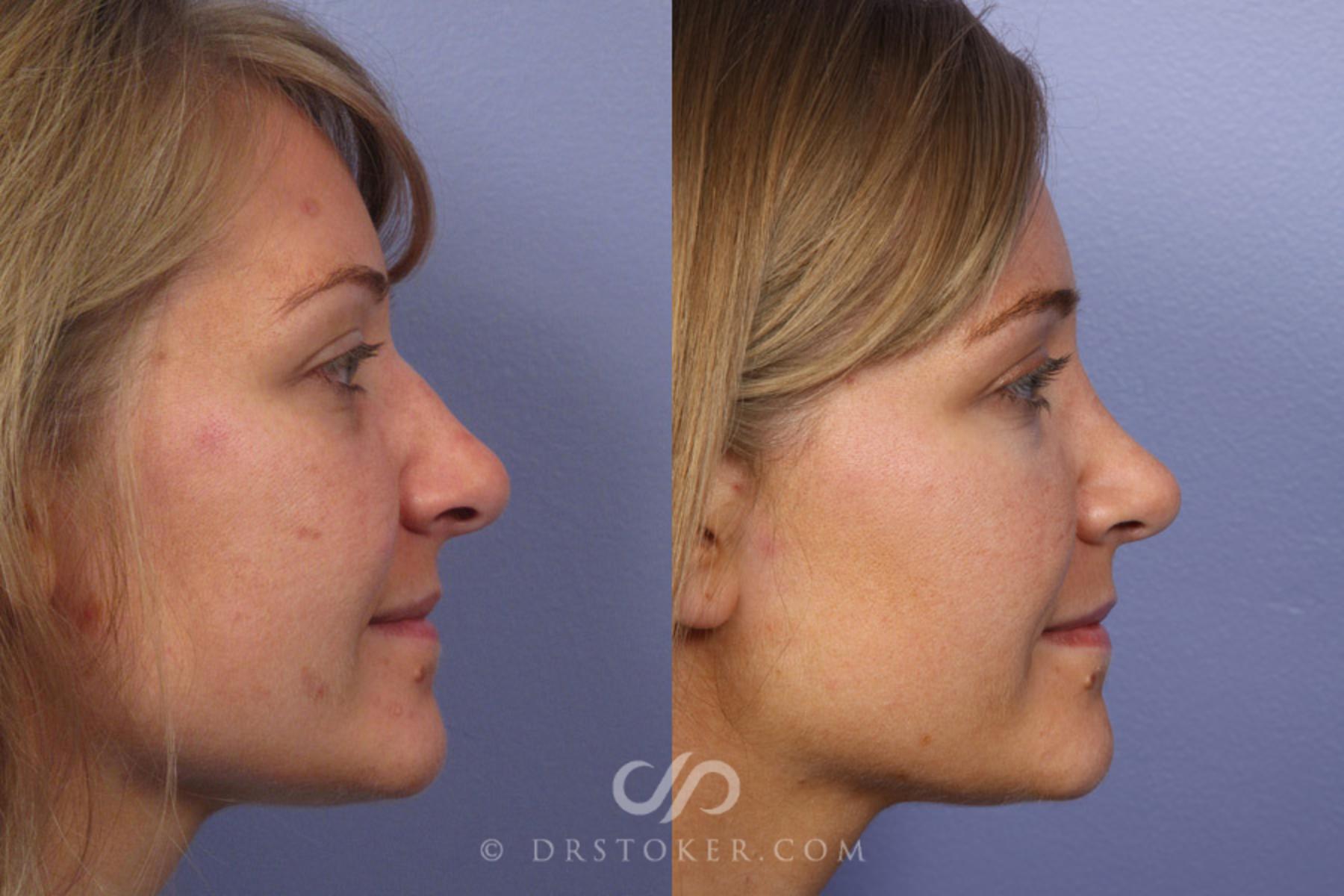 Before & After Rhinoplasty Case 351 View #4 View in Los Angeles, CA
