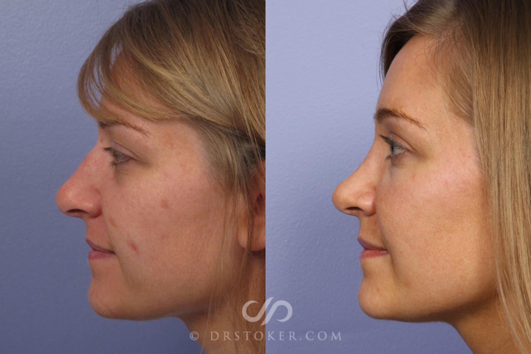 Before & After Rhinoplasty Case 351 View #5 View in Los Angeles, CA