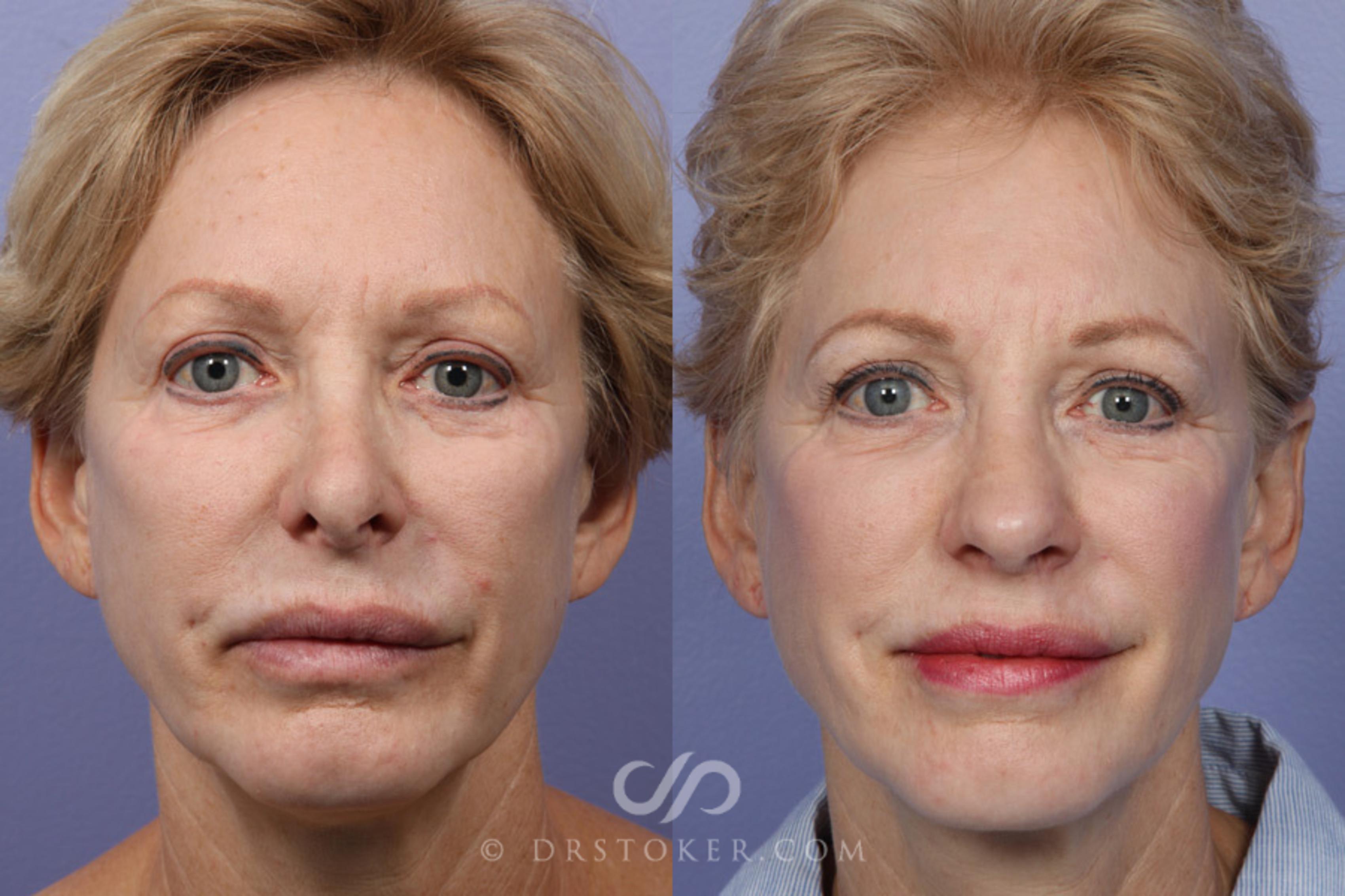 Before & After Rhinoplasty Case 352 View #1 View in Los Angeles, CA