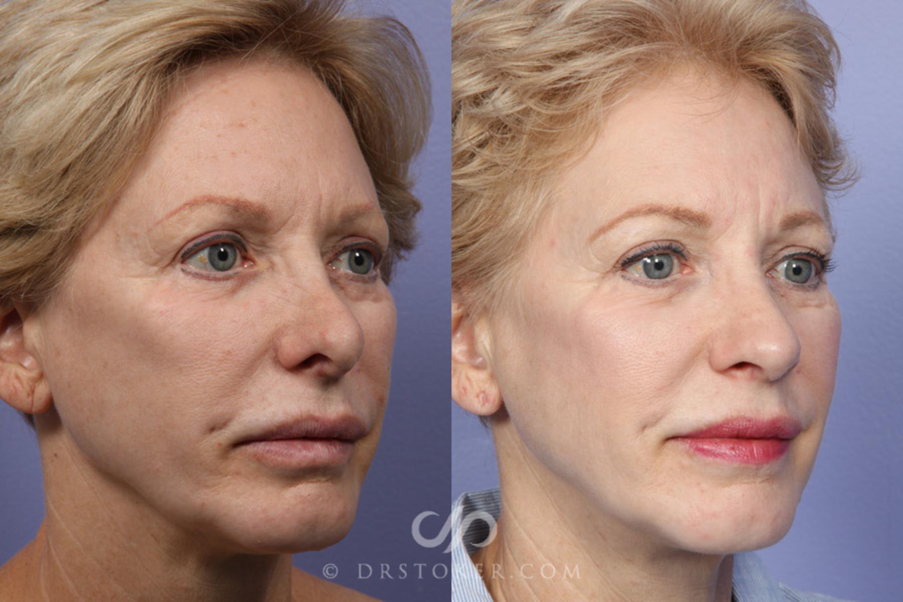 Before & After Rhinoplasty Case 352 View #2 View in Los Angeles, CA