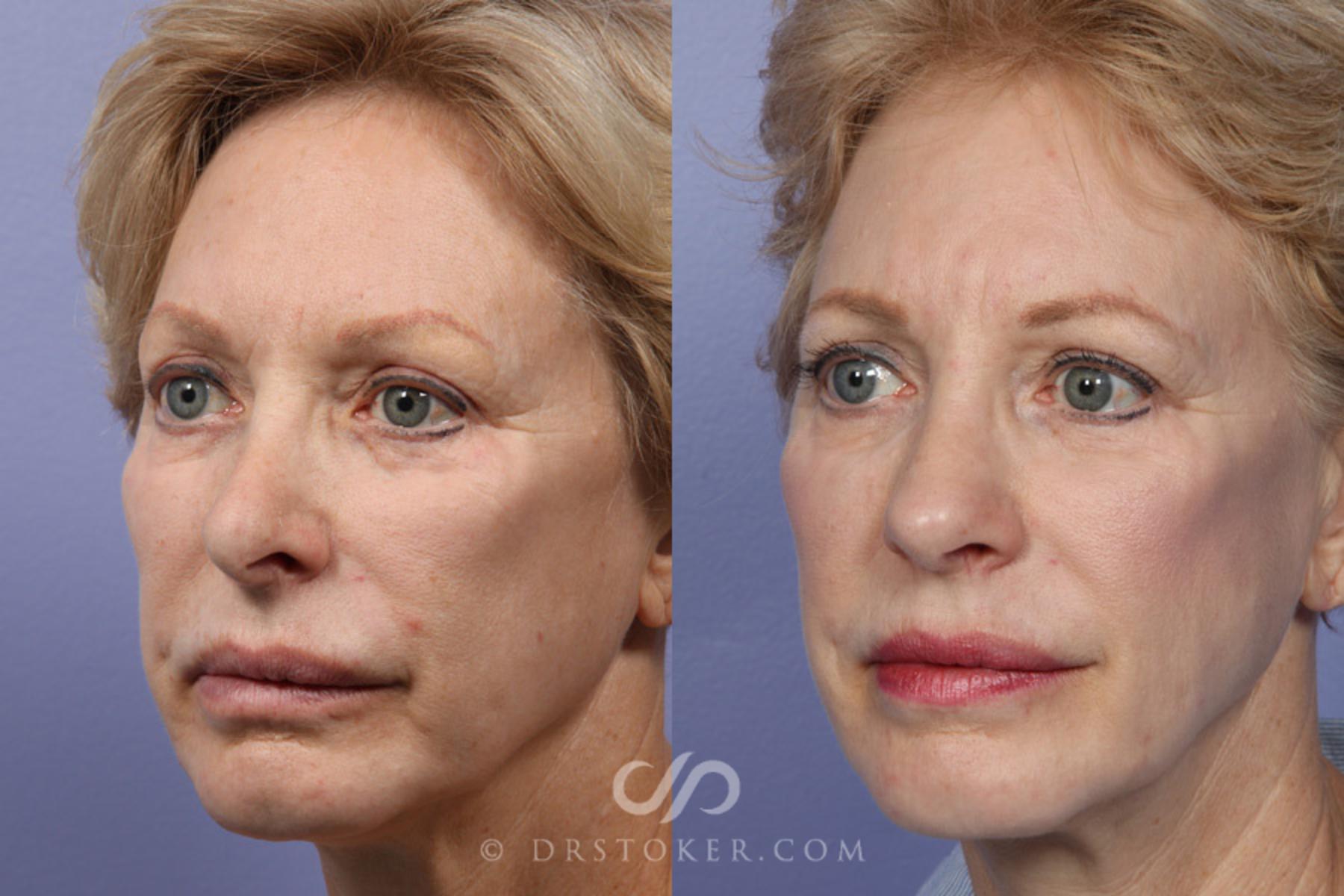 Before & After Rhinoplasty Case 352 View #3 View in Los Angeles, CA