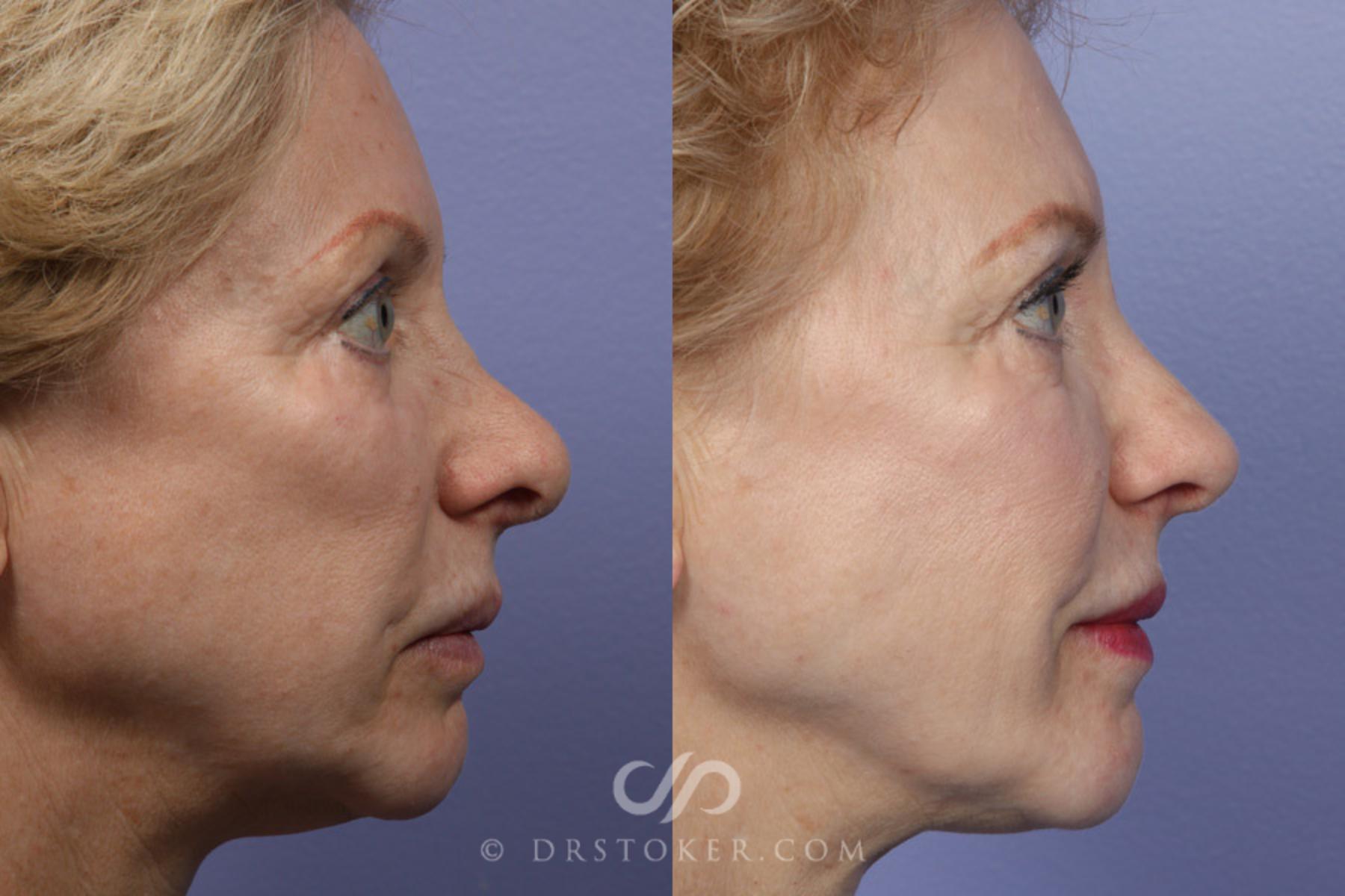 Before & After Rhinoplasty Case 352 View #4 View in Los Angeles, CA