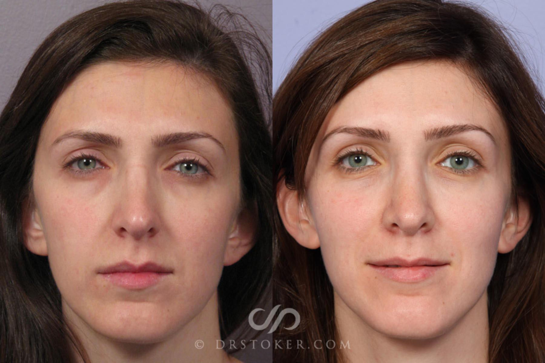Before & After Rhinoplasty Case 353 View #1 View in Los Angeles, CA