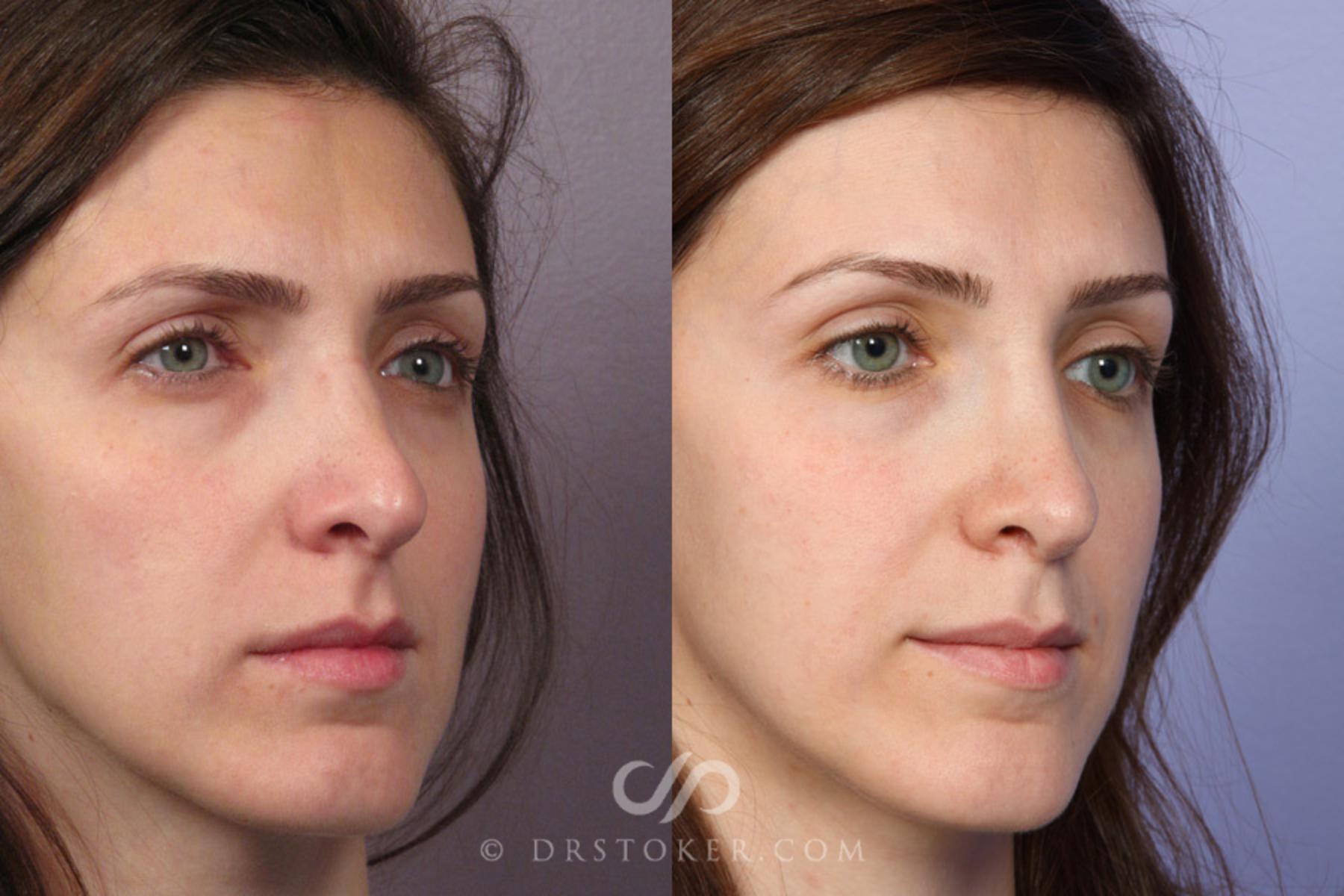 Before & After Rhinoplasty Case 353 View #2 View in Los Angeles, CA