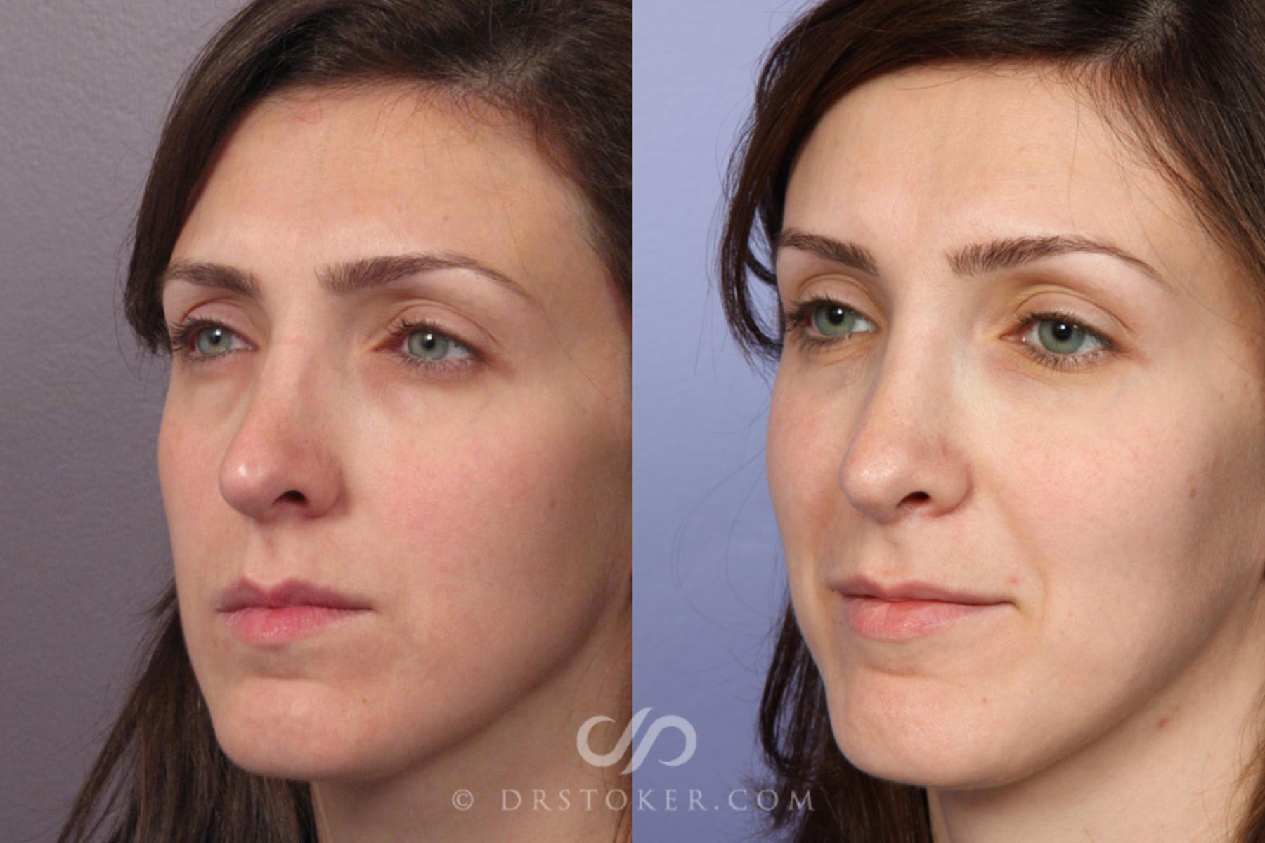 Before & After Rhinoplasty Case 353 View #3 View in Los Angeles, CA