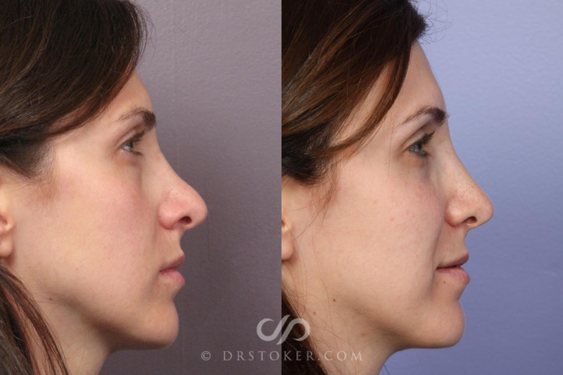 Before & After Rhinoplasty Case 353 View #4 View in Los Angeles, CA