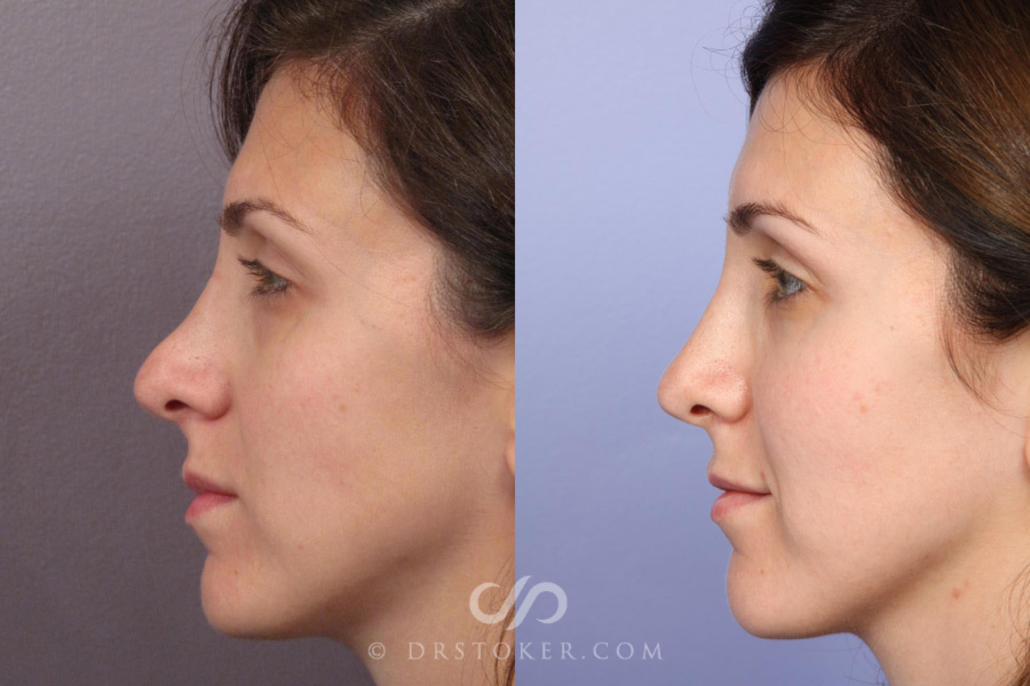 Before & After Rhinoplasty Case 353 View #5 View in Los Angeles, CA
