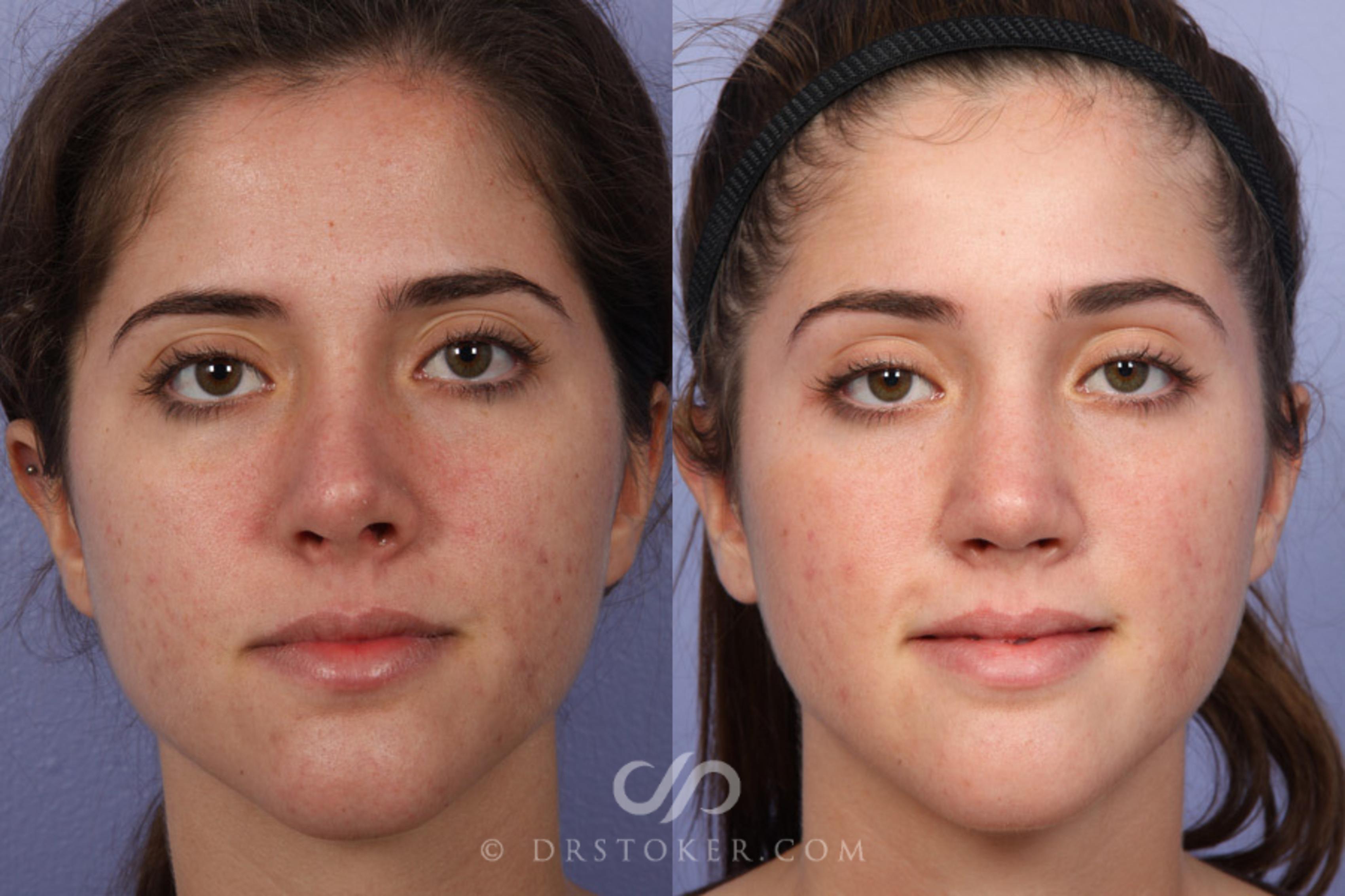 Before & After Rhinoplasty Case 363 View #1 View in Los Angeles, CA
