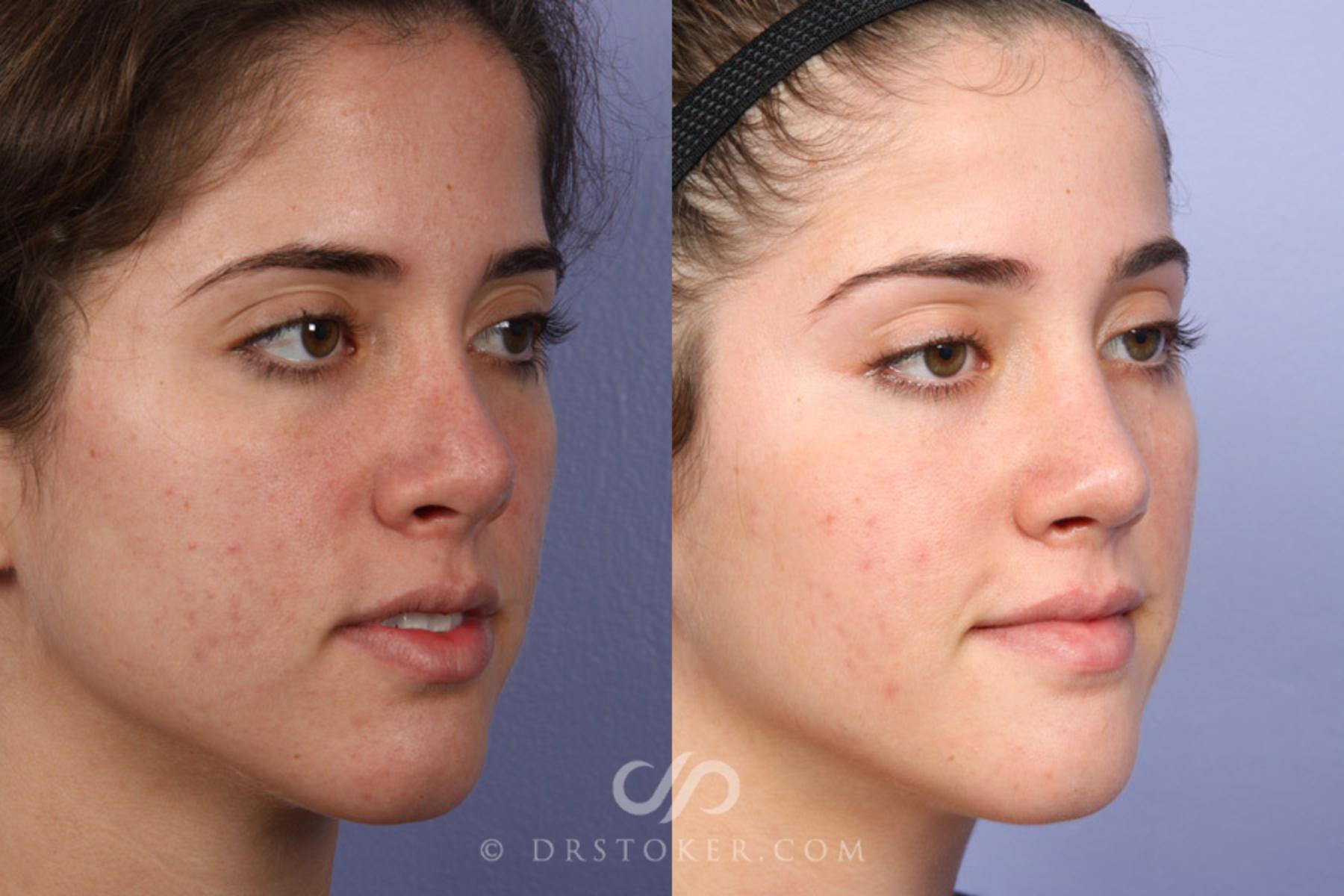 Before & After Rhinoplasty Case 363 View #2 View in Los Angeles, CA