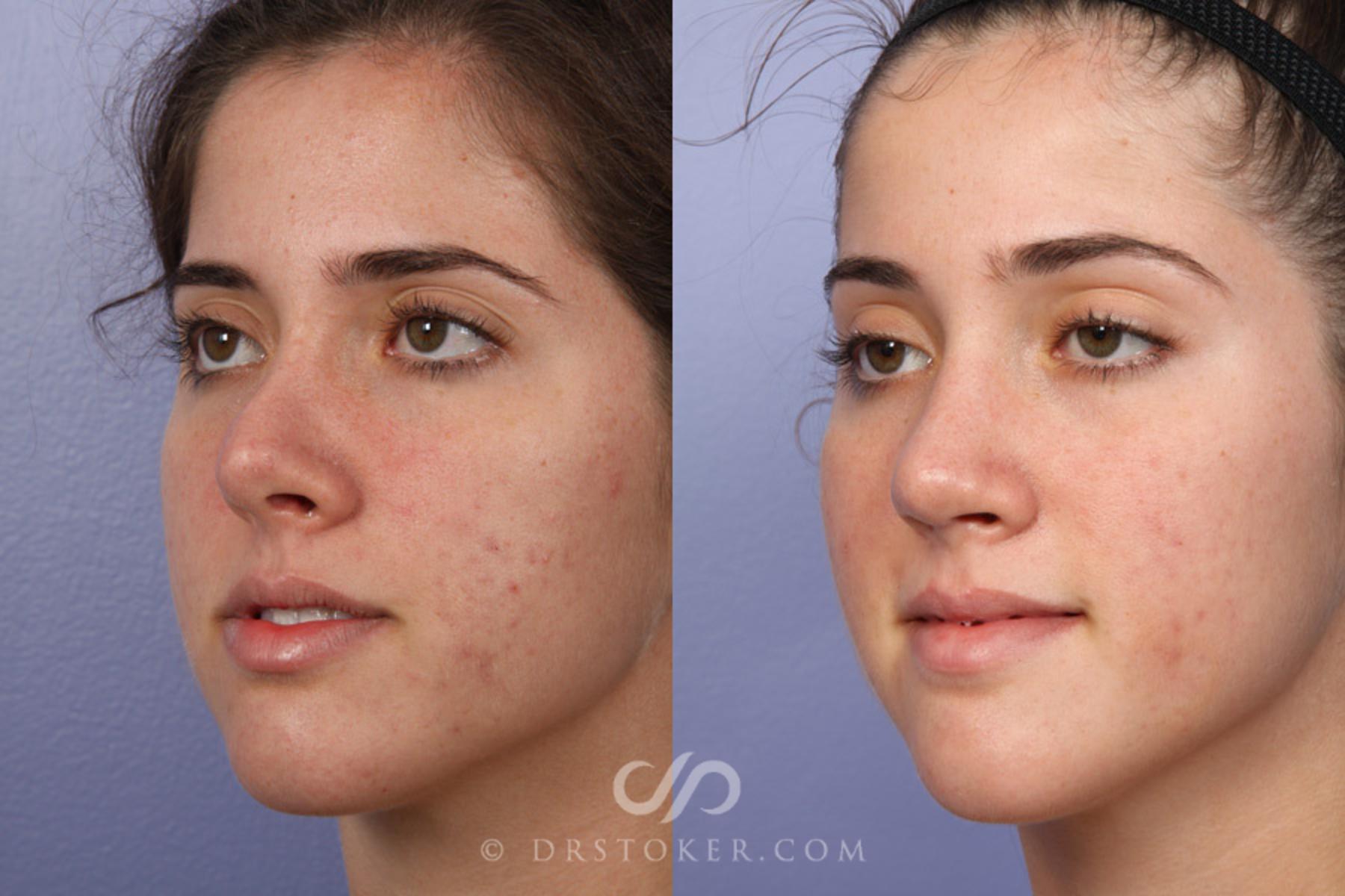 Before & After Rhinoplasty Case 363 View #3 View in Los Angeles, CA