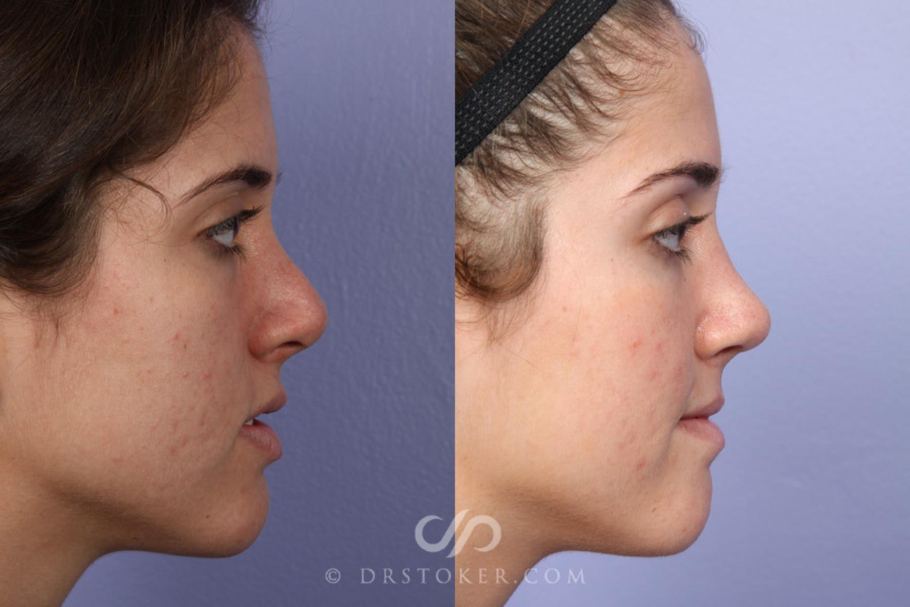 Before & After Rhinoplasty Case 363 View #4 View in Los Angeles, CA