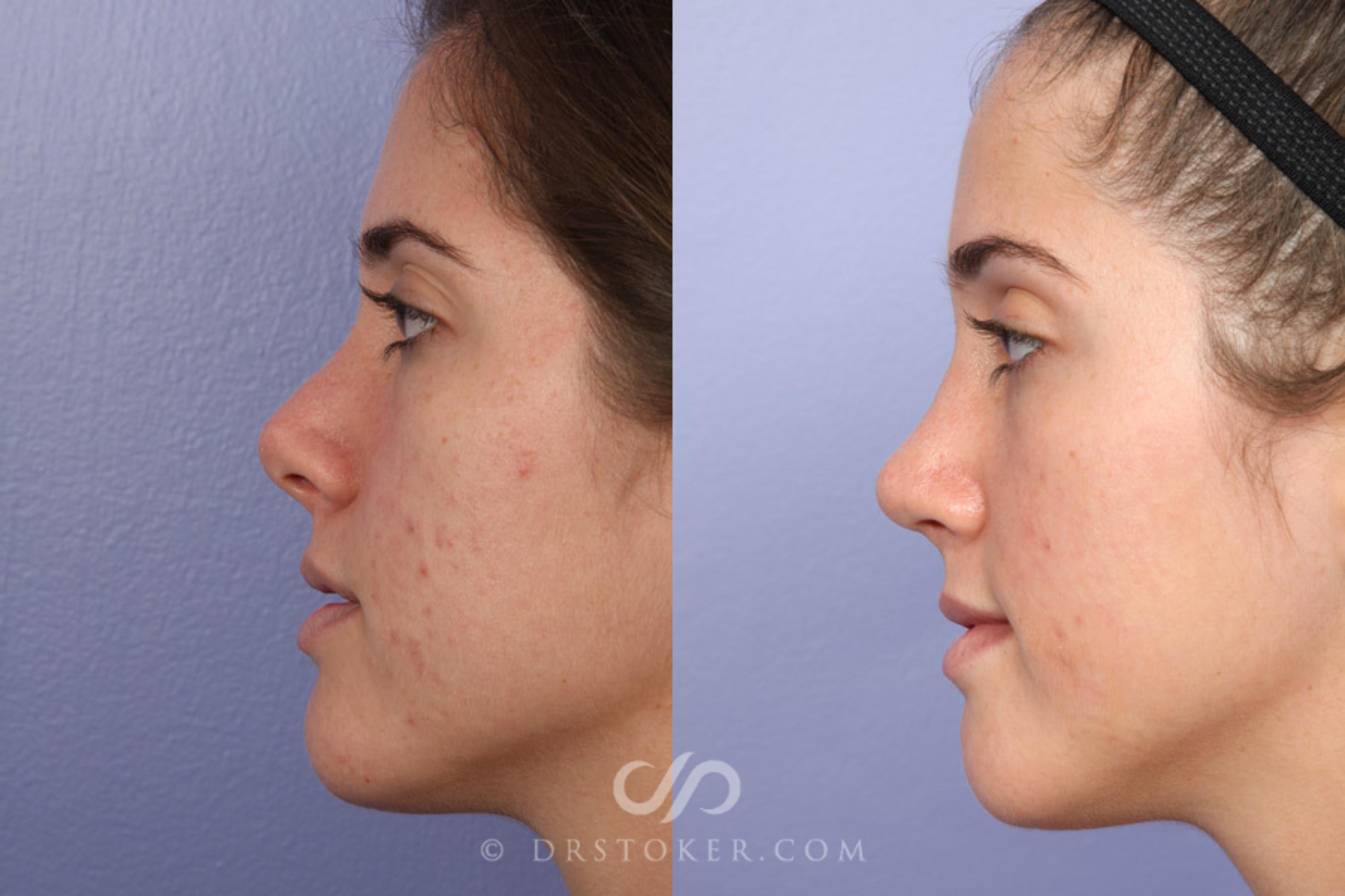 Before & After Rhinoplasty Case 363 View #5 View in Los Angeles, CA