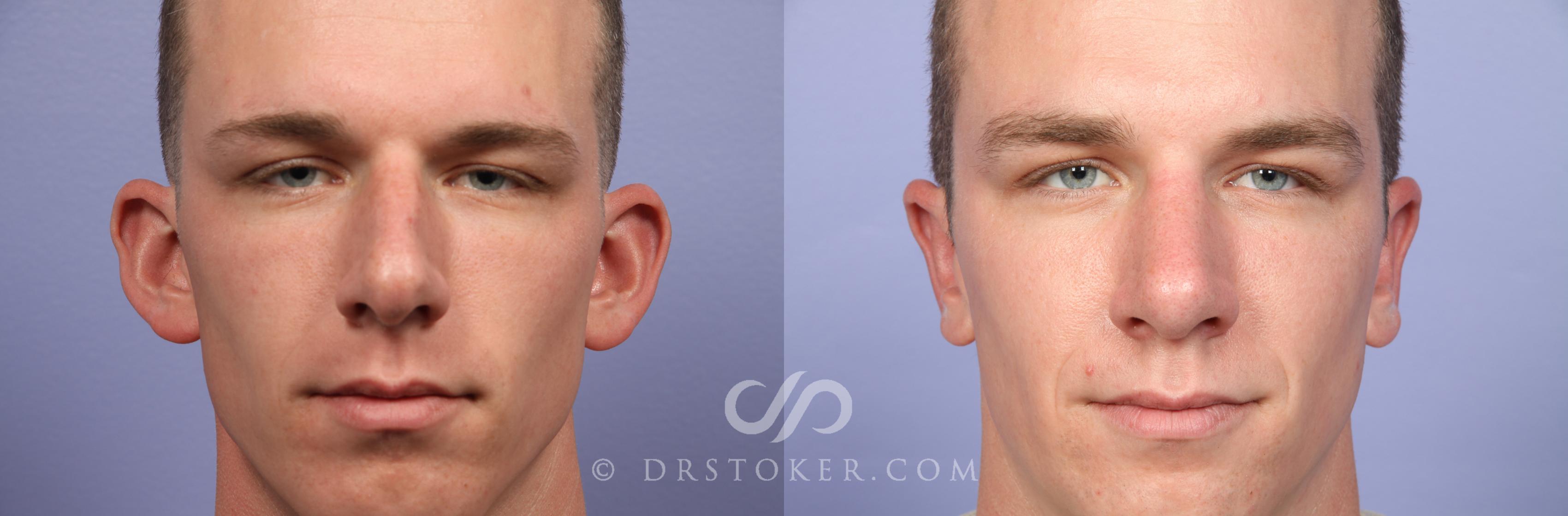Before & After Rhinoplasty Case 417 View #1 View in Los Angeles, CA