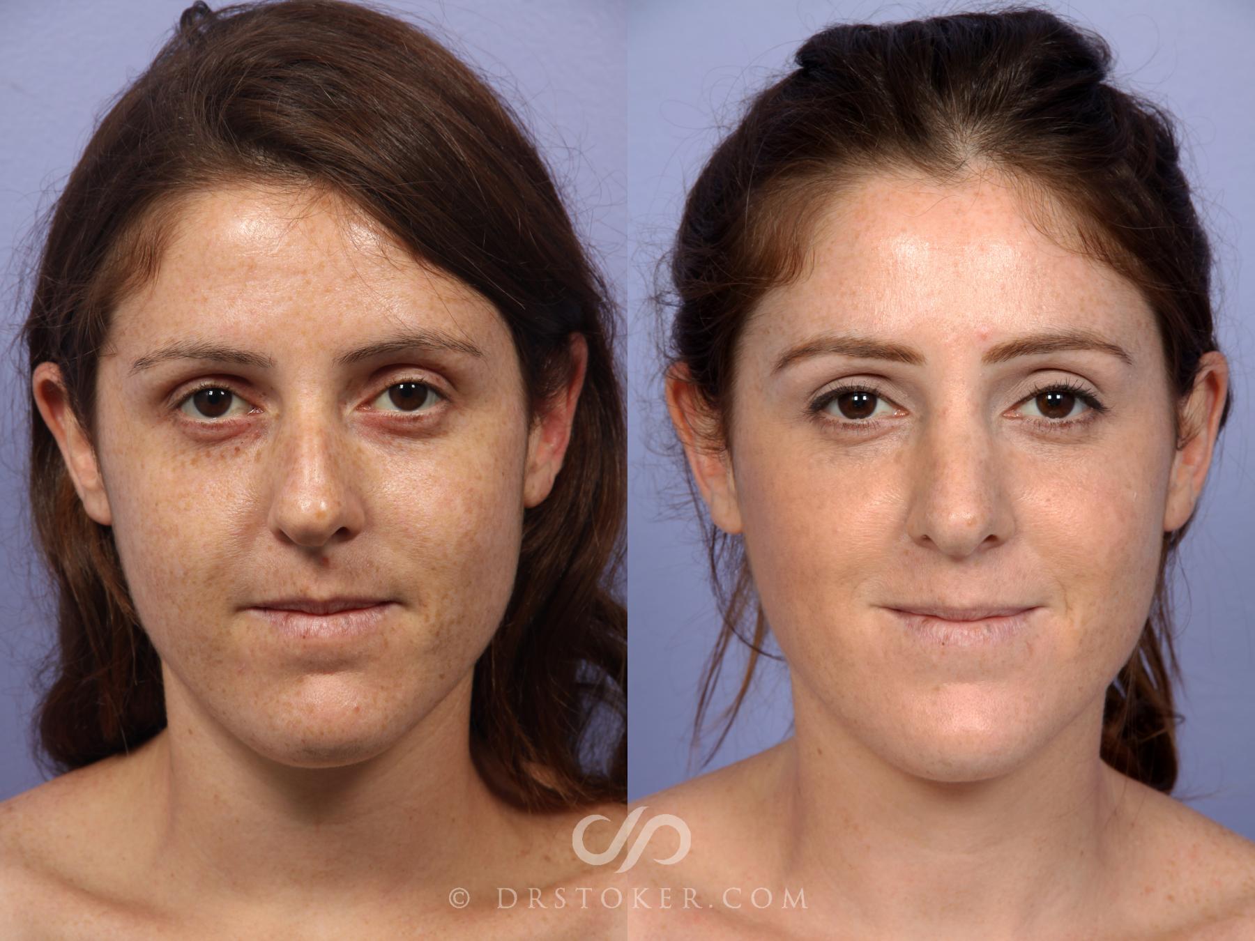 Before & After Rhinoplasty Case 435 View #1 View in Los Angeles, CA