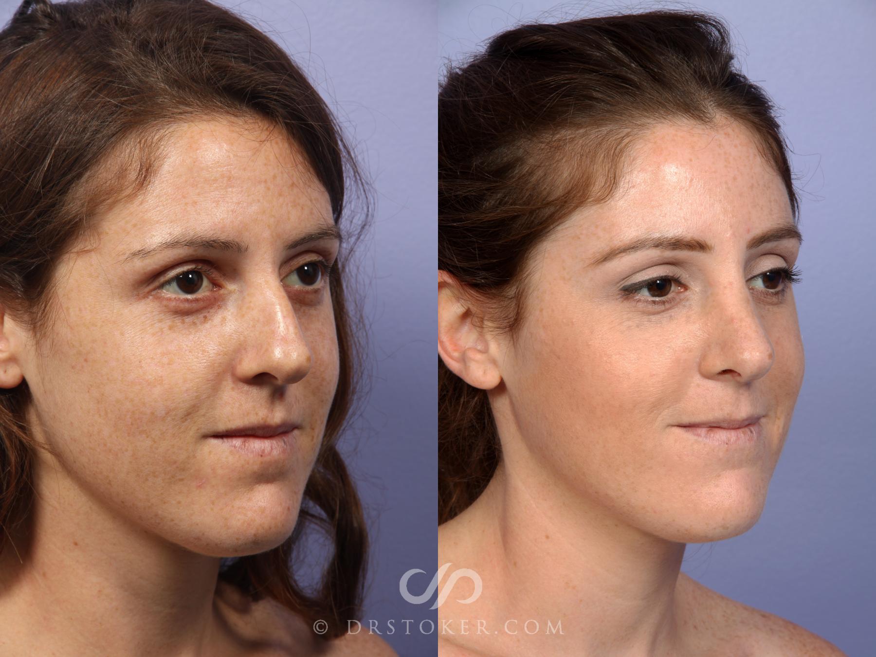 Before & After Rhinoplasty Case 435 View #2 View in Los Angeles, CA