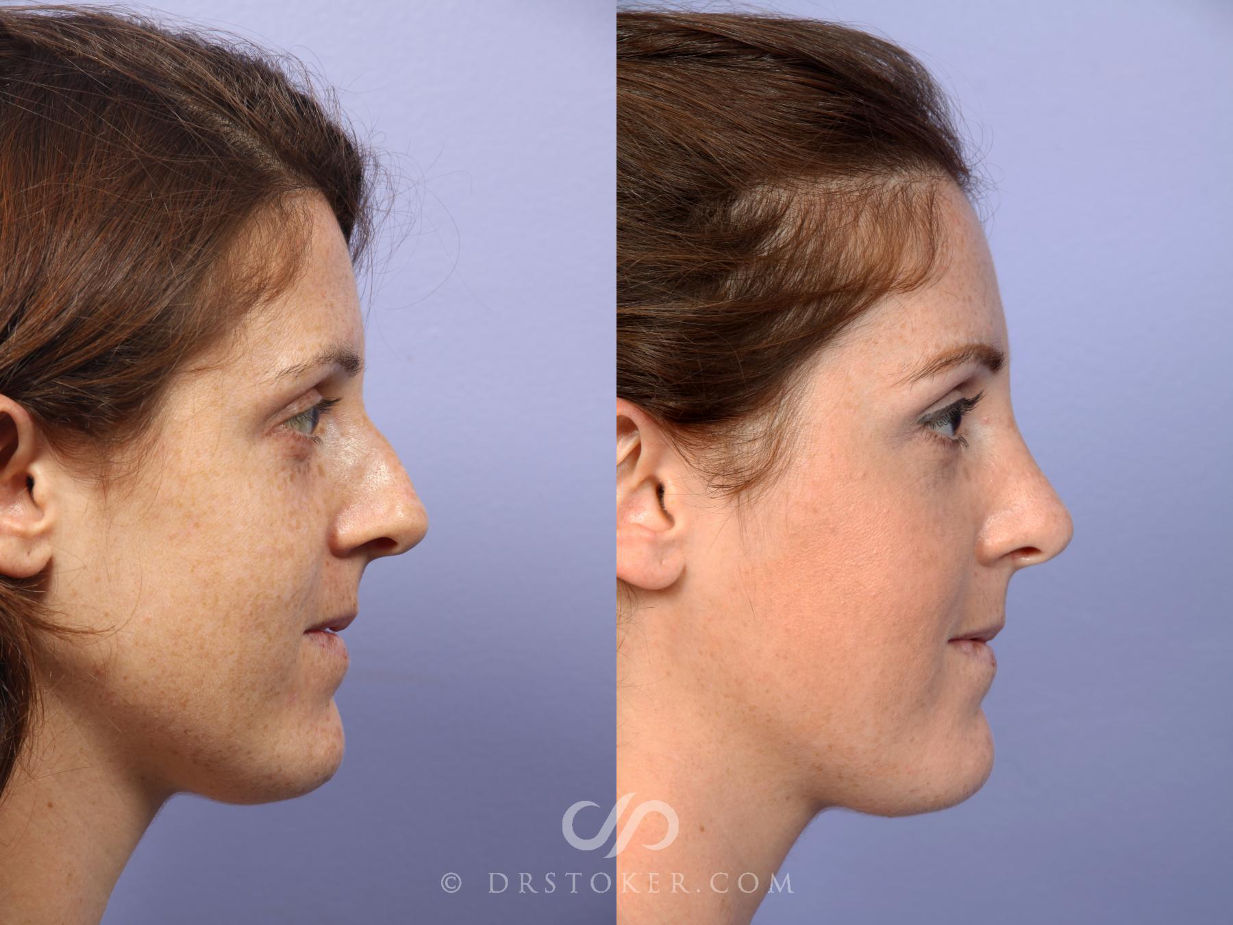 Before & After Rhinoplasty Case 435 View #3 View in Los Angeles, CA
