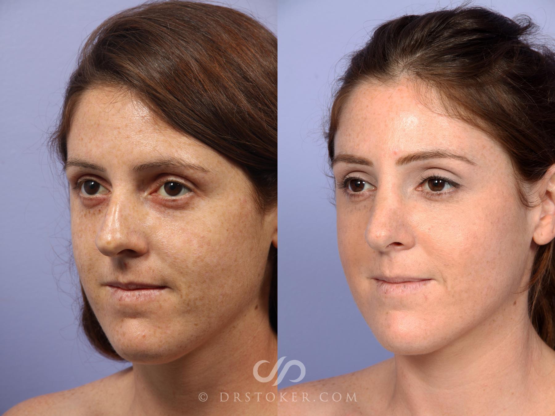 Before & After Rhinoplasty Case 435 View #4 View in Los Angeles, CA