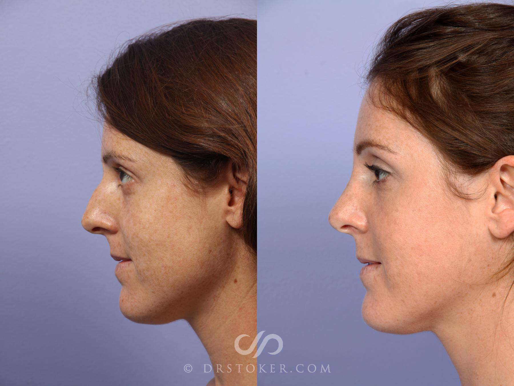 Before & After Rhinoplasty Case 435 View #5 View in Los Angeles, CA