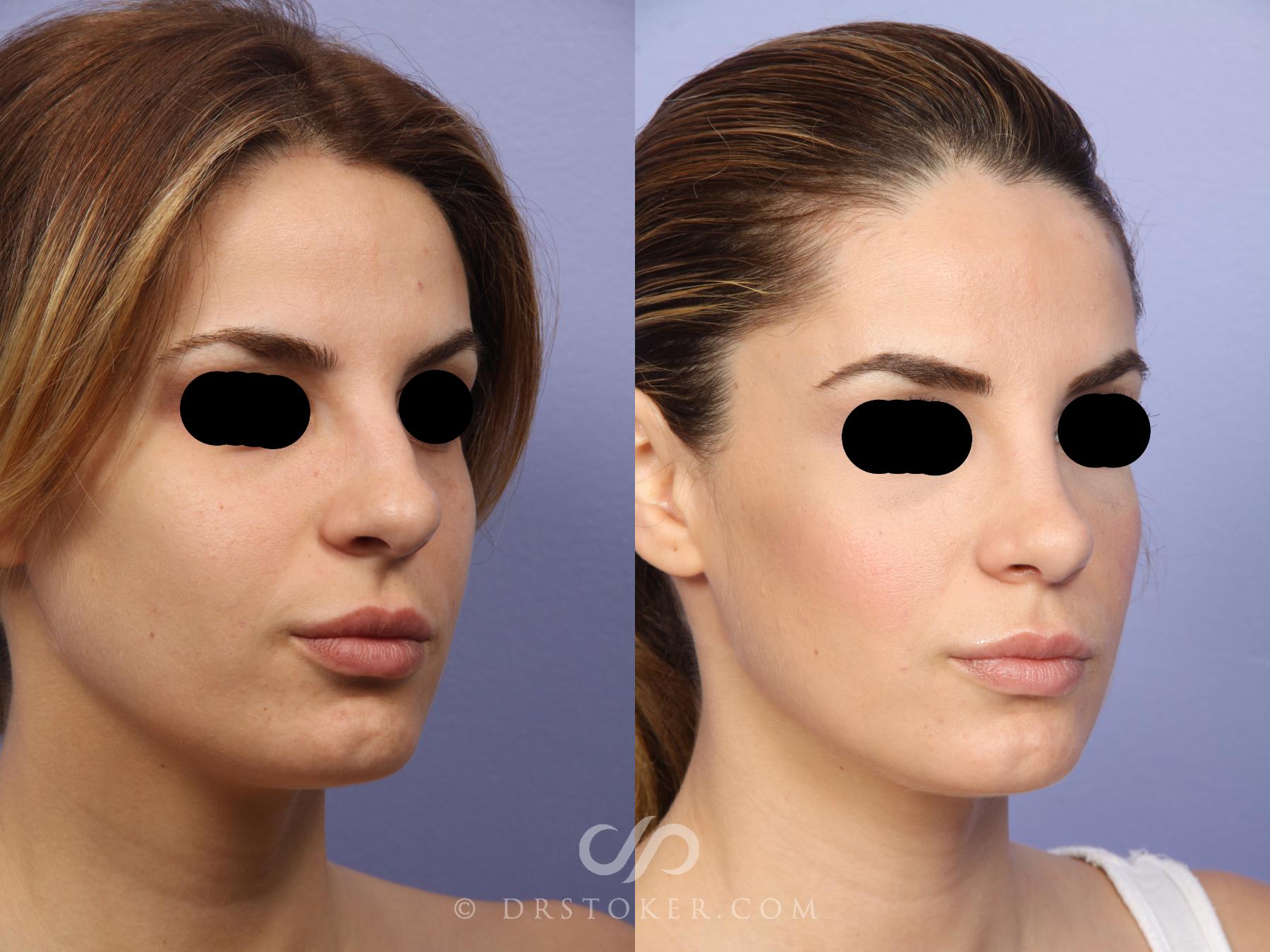 Before & After Rhinoplasty Case 467 View #2 View in Los Angeles, CA