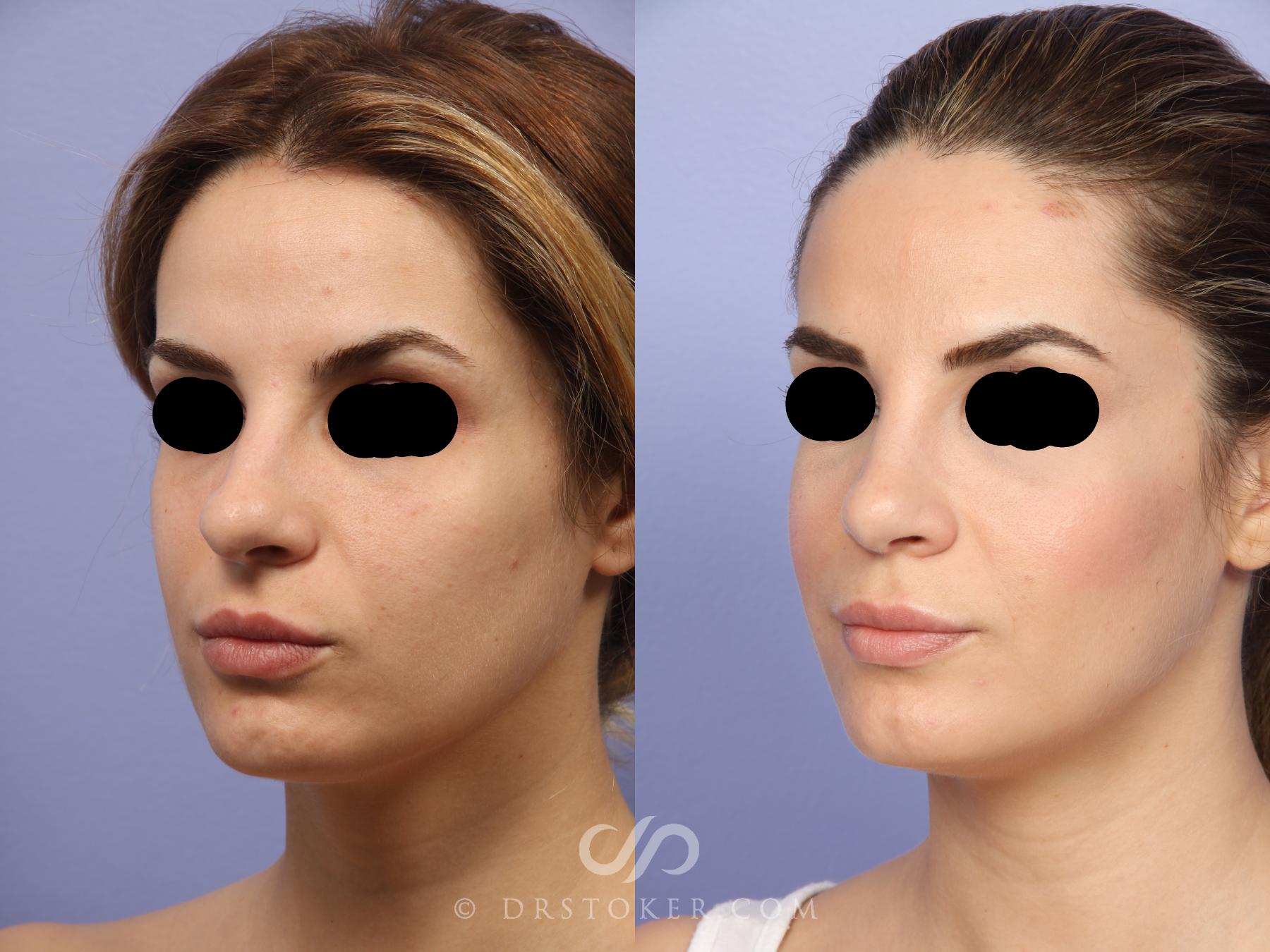Before & After Rhinoplasty Case 467 View #3 View in Los Angeles, CA