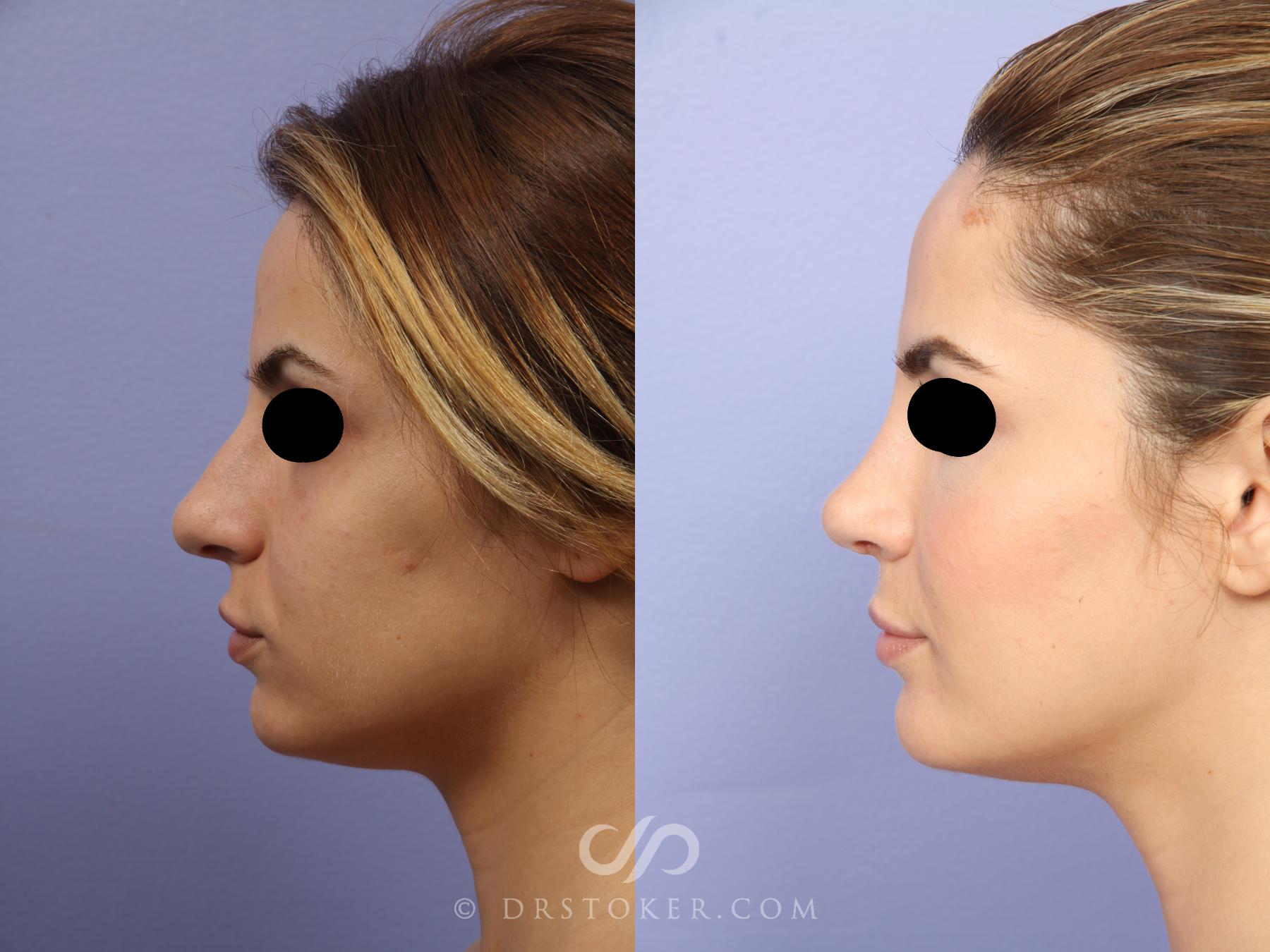 Before & After Rhinoplasty Case 467 View #5 View in Los Angeles, CA