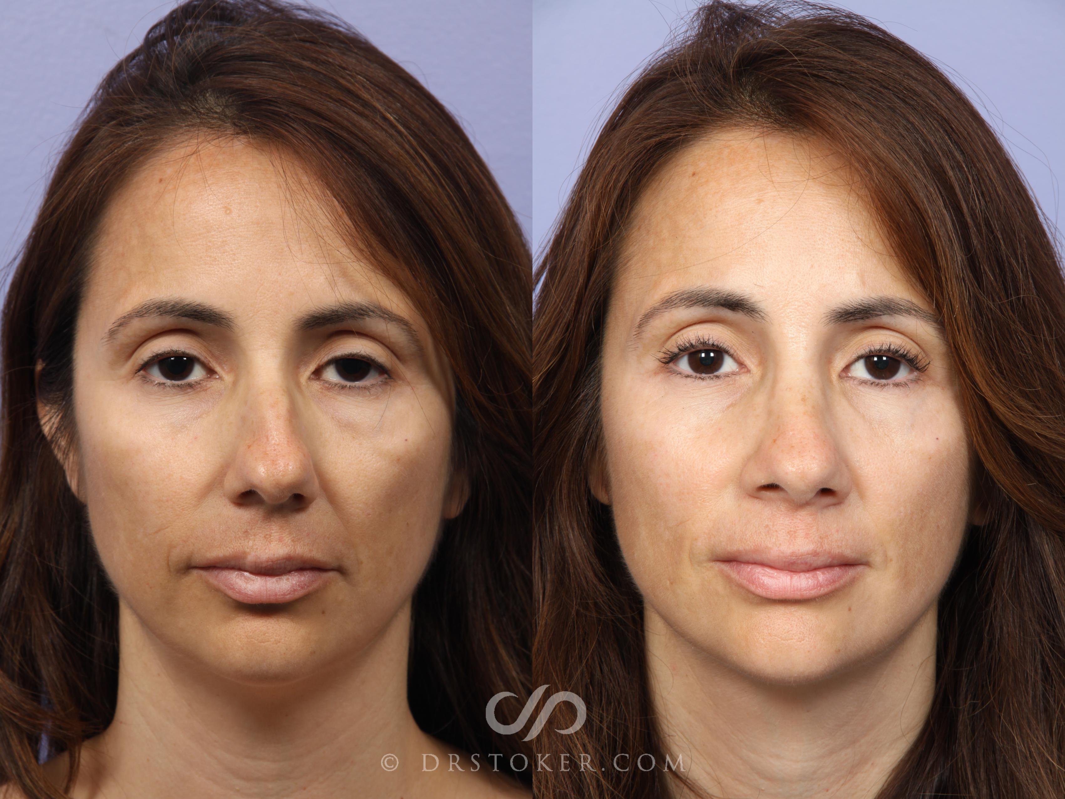Before & After Rhinoplasty Case 468 View #1 View in Los Angeles, CA