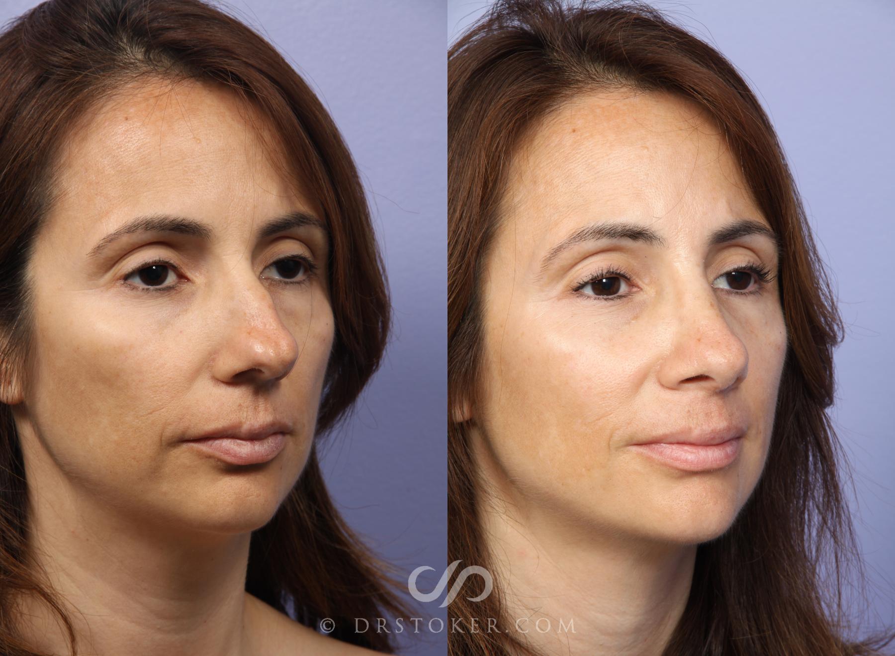 Before & After Rhinoplasty Case 468 View #2 View in Los Angeles, CA