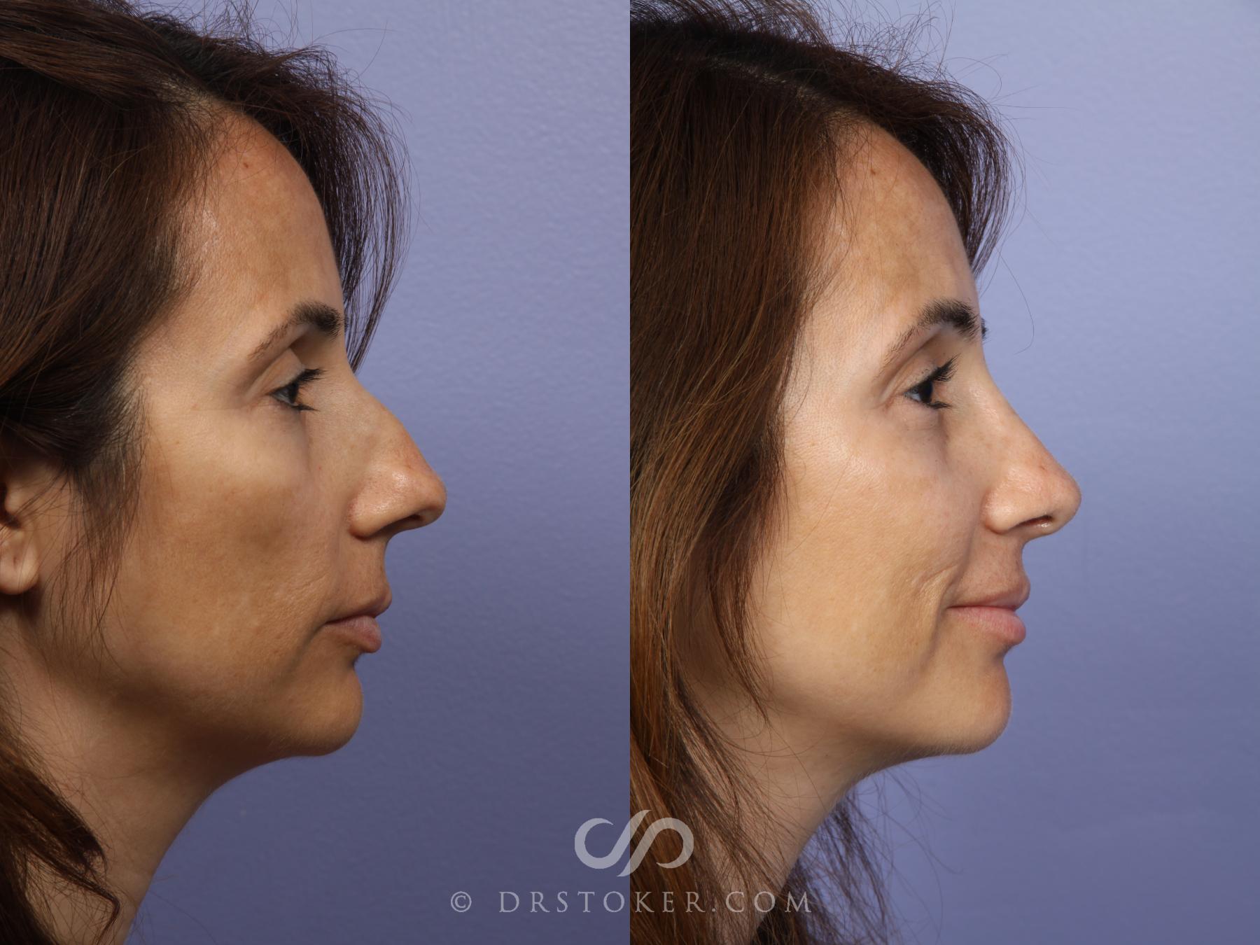 Before & After Rhinoplasty Case 468 View #3 View in Los Angeles, CA