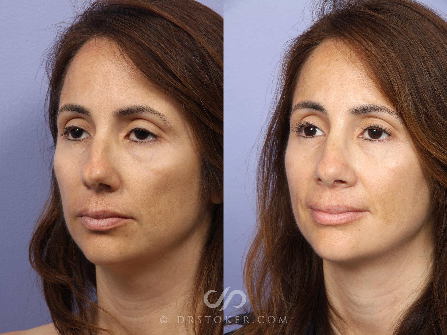 Before & After Rhinoplasty Case 468 View #4 View in Los Angeles, CA