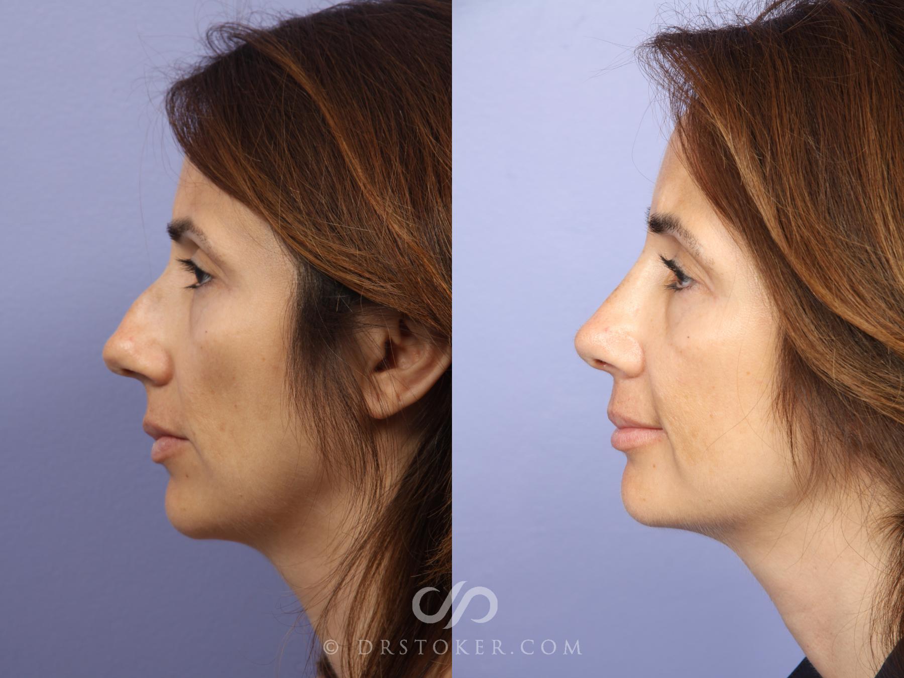 Before & After Rhinoplasty Case 468 View #5 View in Los Angeles, CA