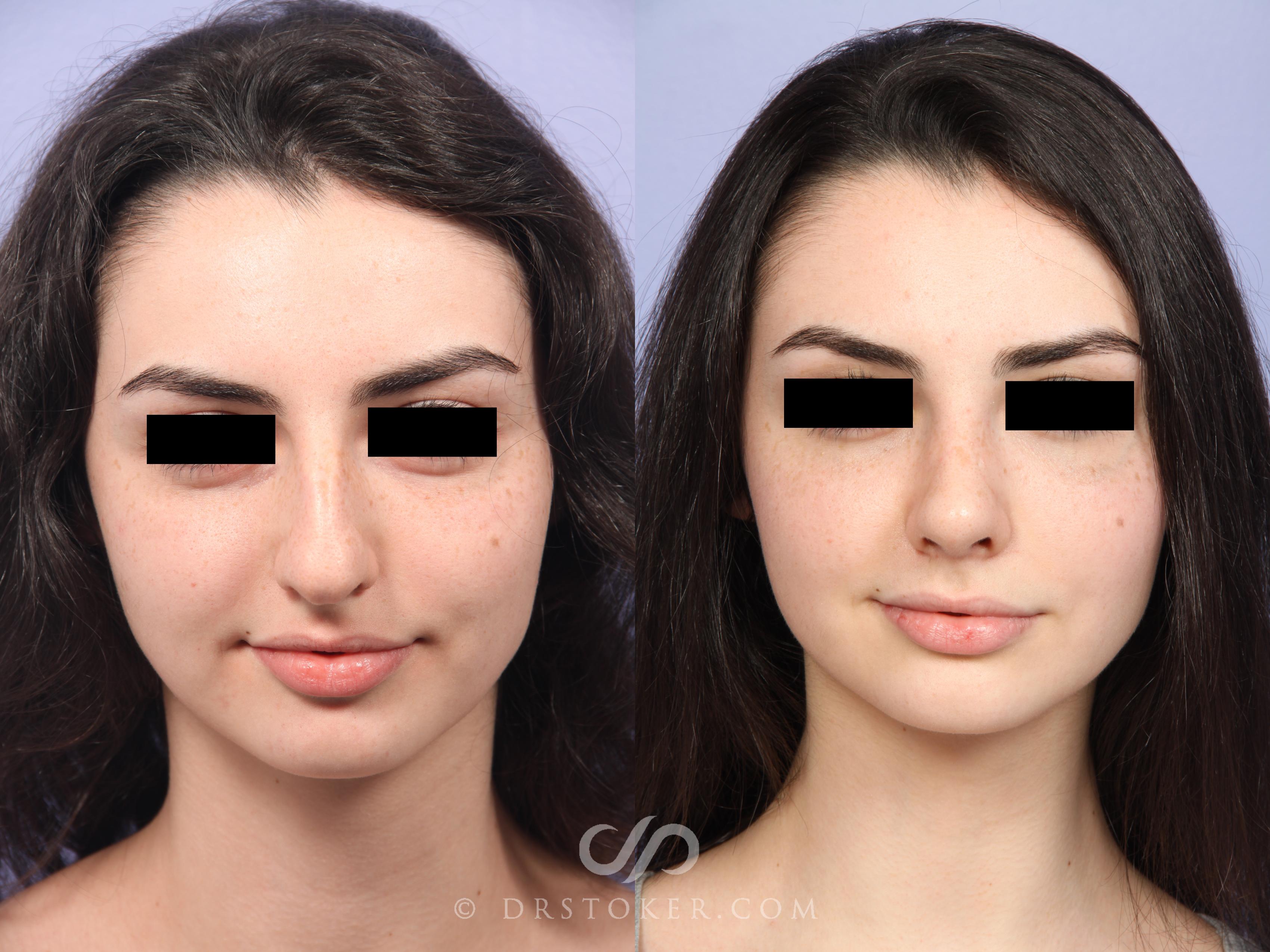 Before & After Rhinoplasty Case 521 View #1 View in Los Angeles, CA