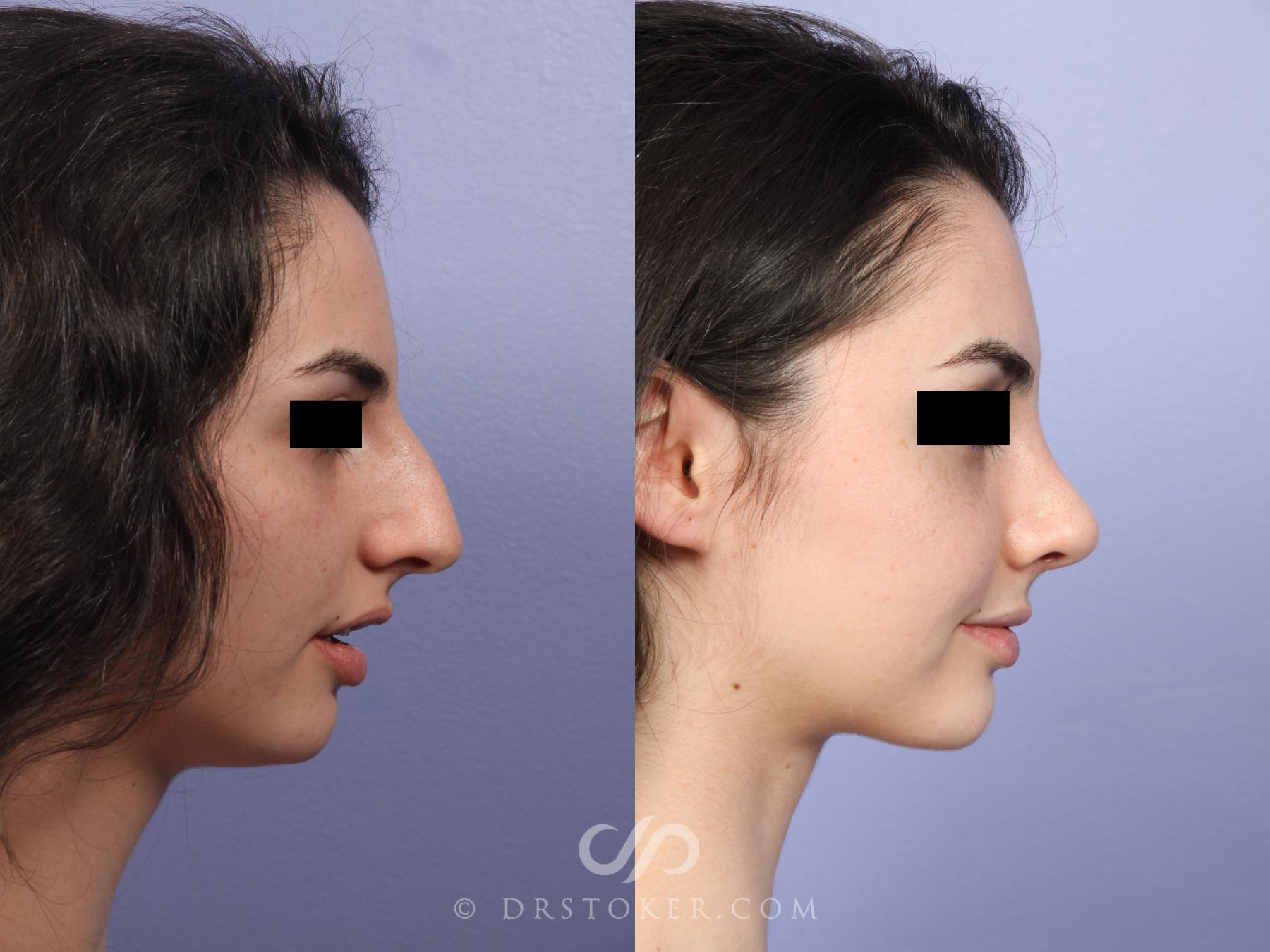 Before & After Rhinoplasty Case 521 View #3 View in Los Angeles, CA