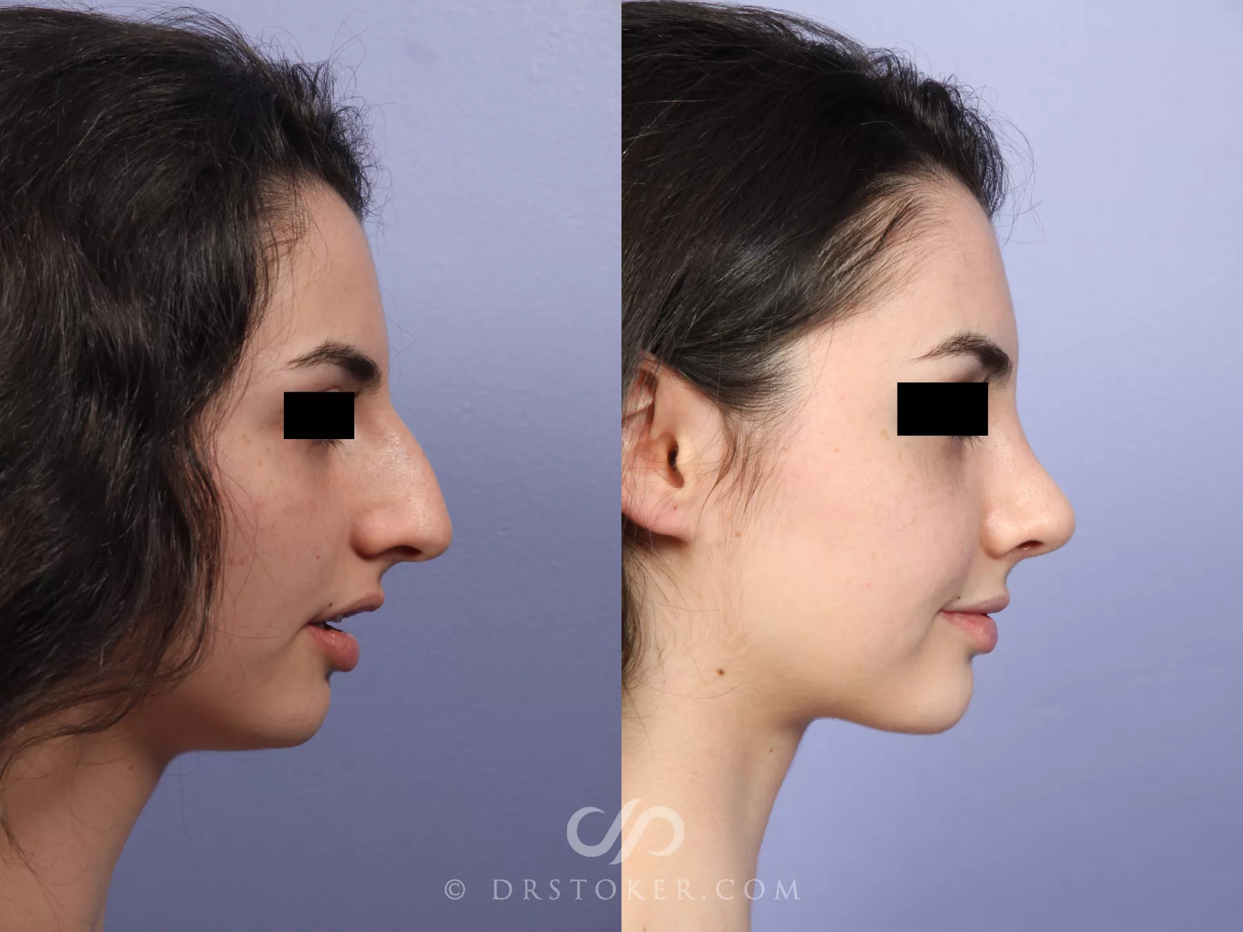 Premium Photo  Transformation of woman's nose through rhinoplasty Before  and after images showcasing enhanced facial harmony and refined nasal  contour AI generated