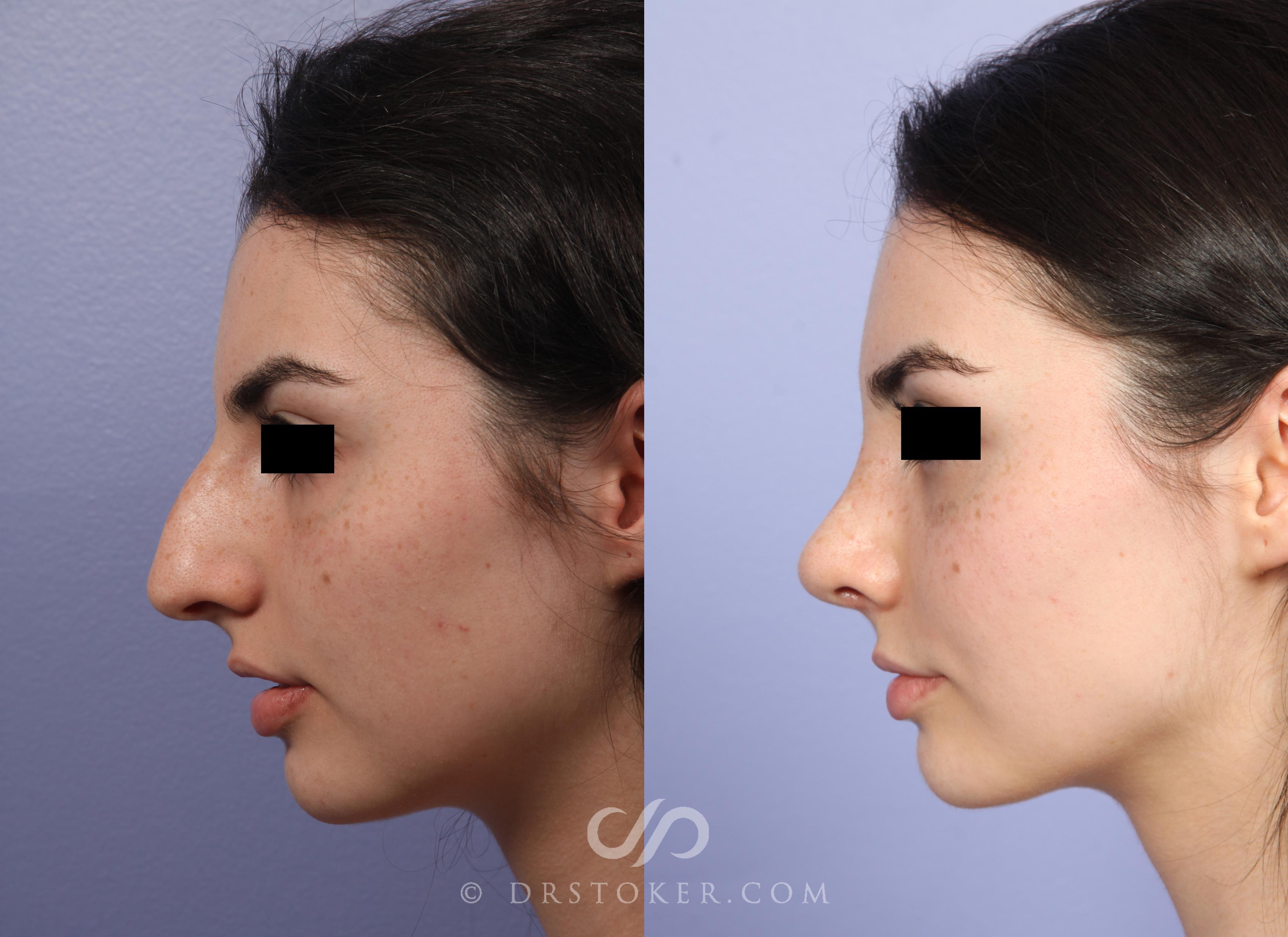 Before & After Rhinoplasty Case 521 View #4 View in Los Angeles, CA