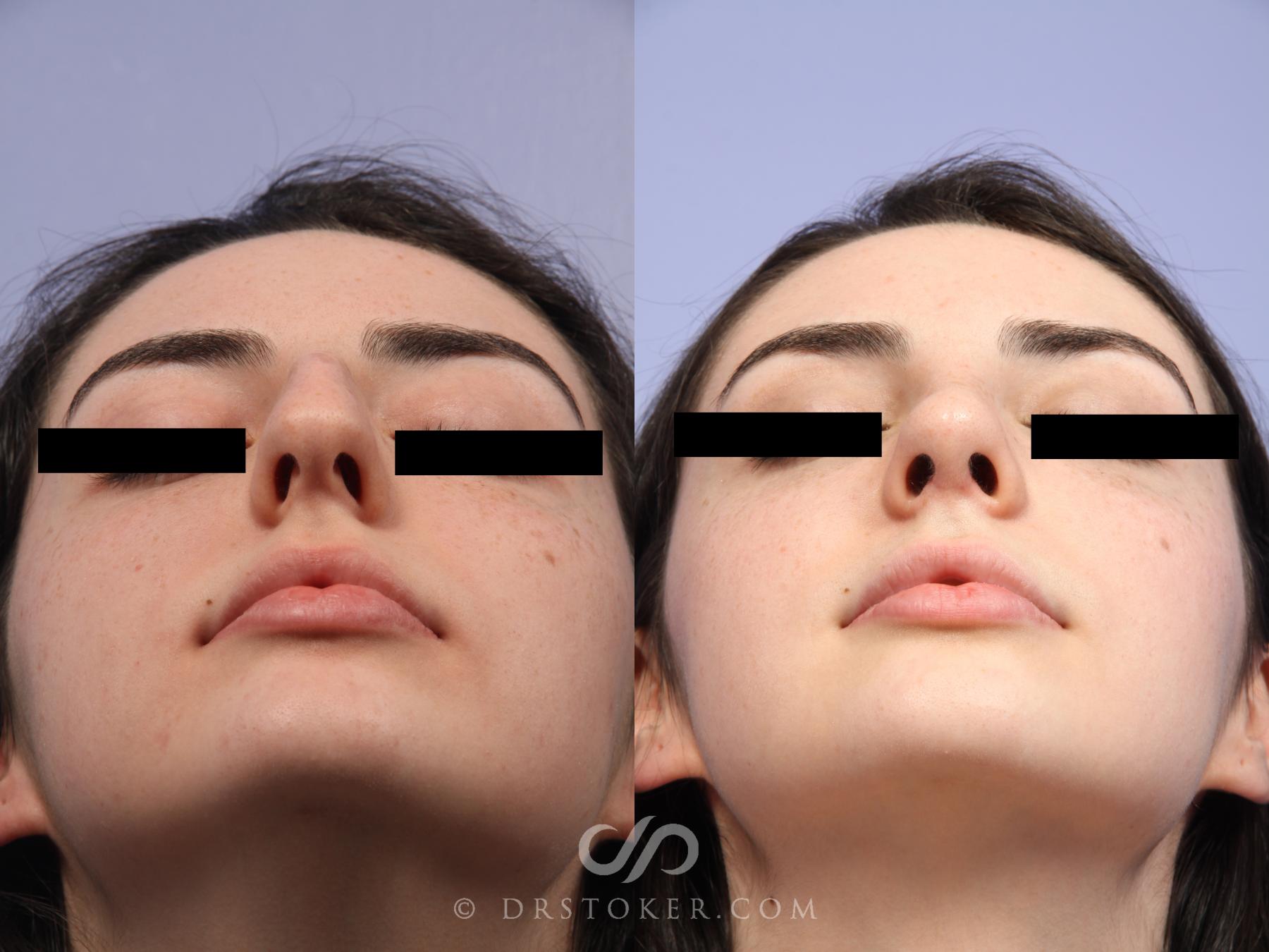 Before & After Rhinoplasty Case 521 View #5 View in Los Angeles, CA