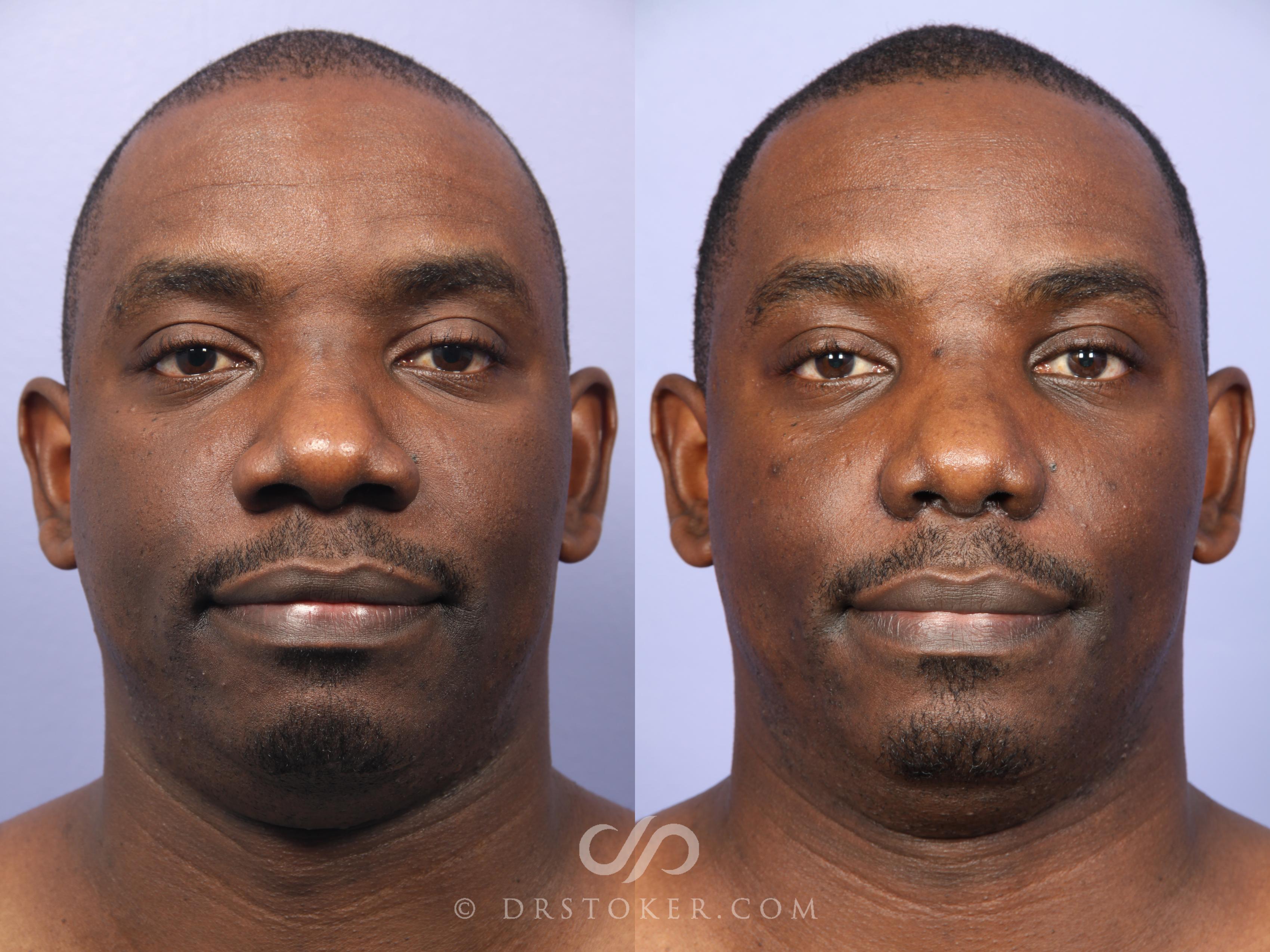 rhinoplasty before and after male